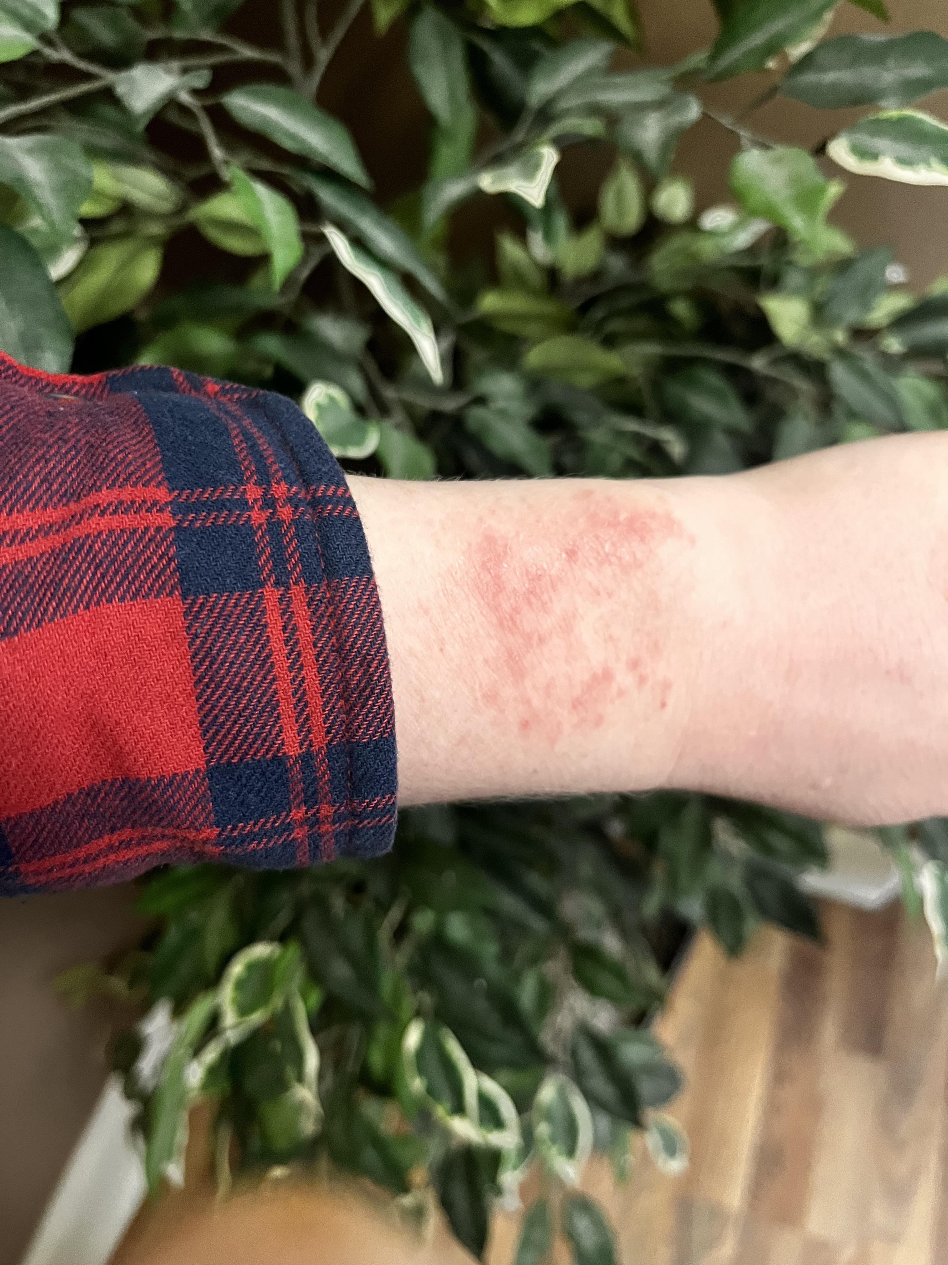 Finally confirmed with an allergist that I have a soy allergy😩😩😩 makes