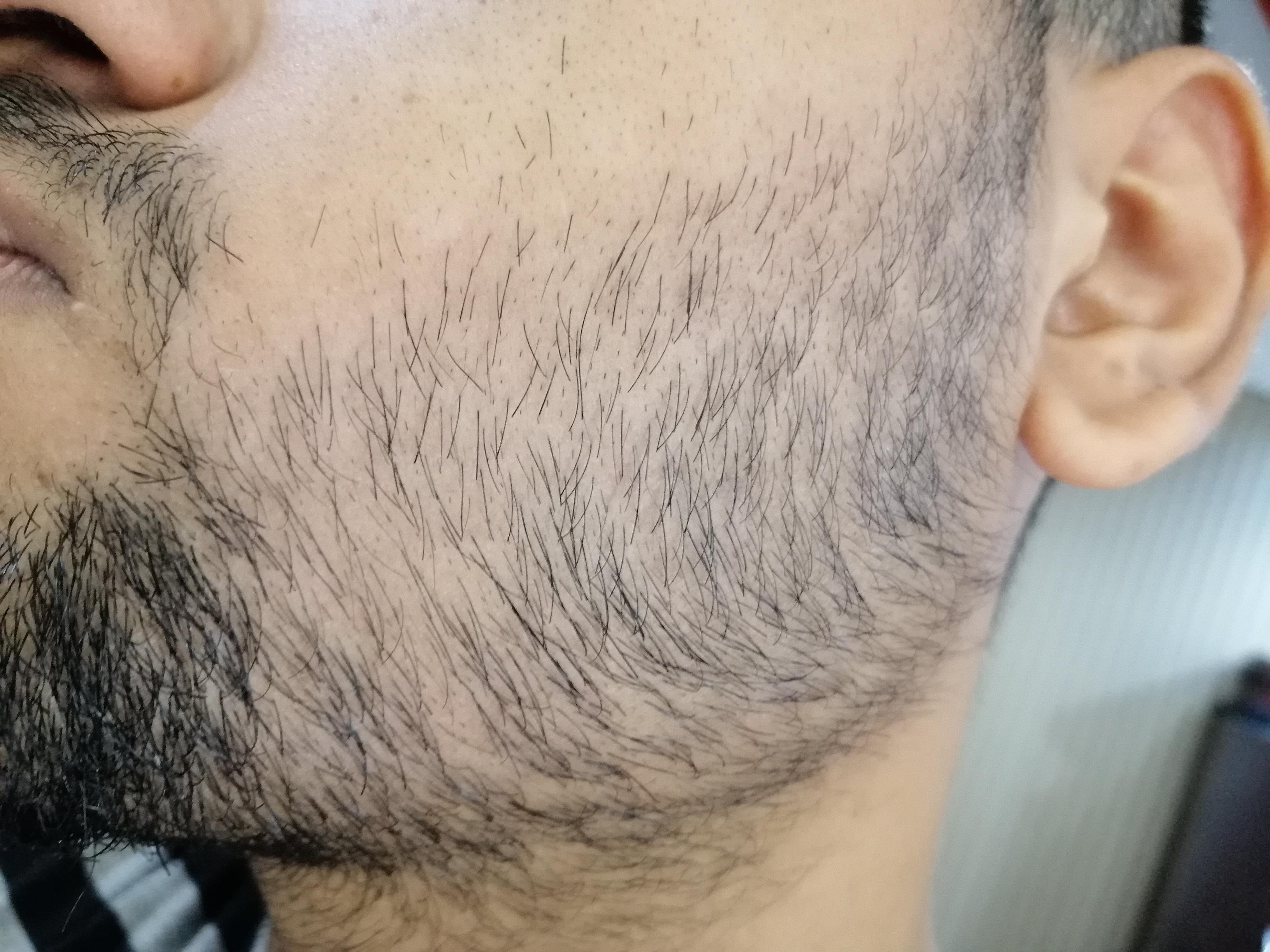 Terminal hair? Why some of my beard hair are growing after the other
