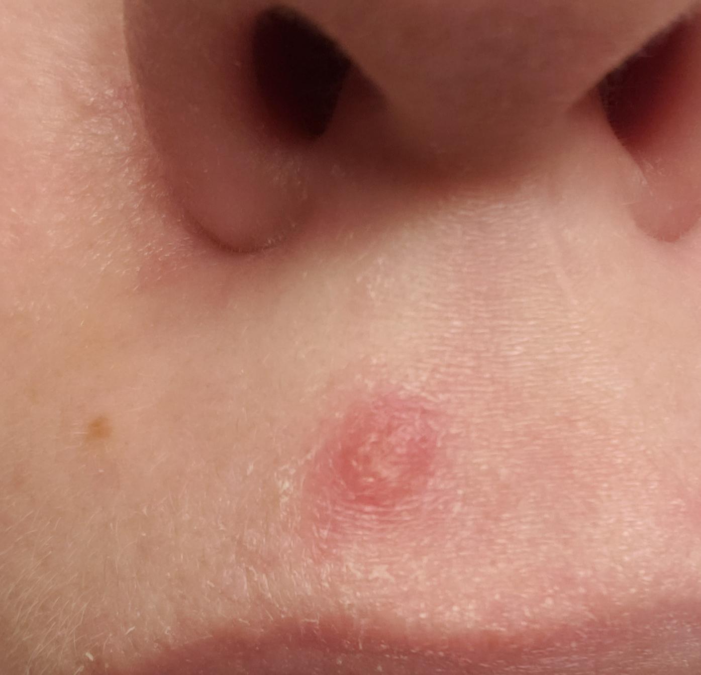 Help! Is this a cold sore or a bad cystic pimple? It's right between my