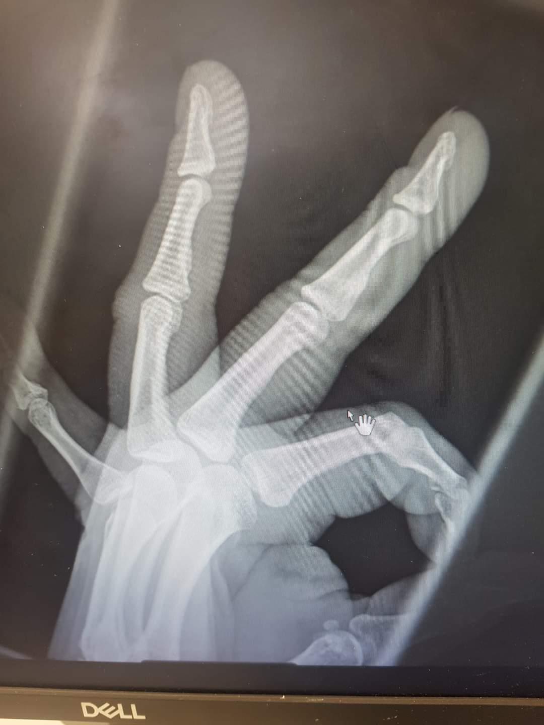 My friend was worried she had broken a bone after her hand got slammed
