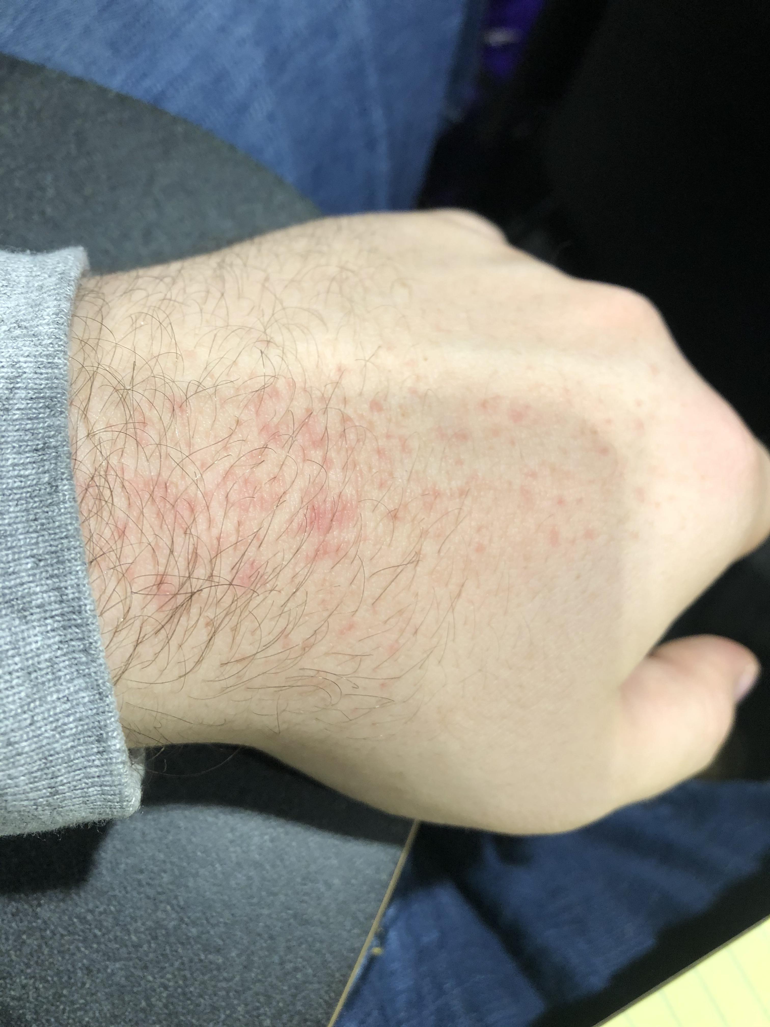 Recurring rash on both hands in the same spot. I can’t identify a cause