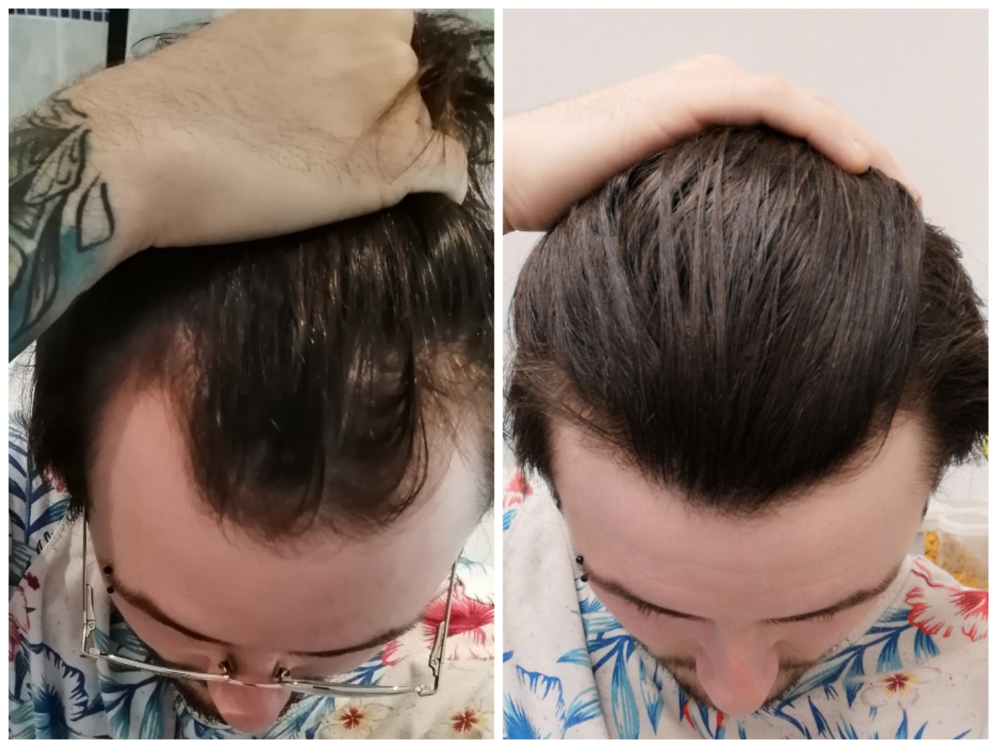 11 month hair update.. The minoxidil and finasteride really work
