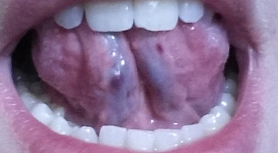 Brown spots under tongue DiagnoseMe