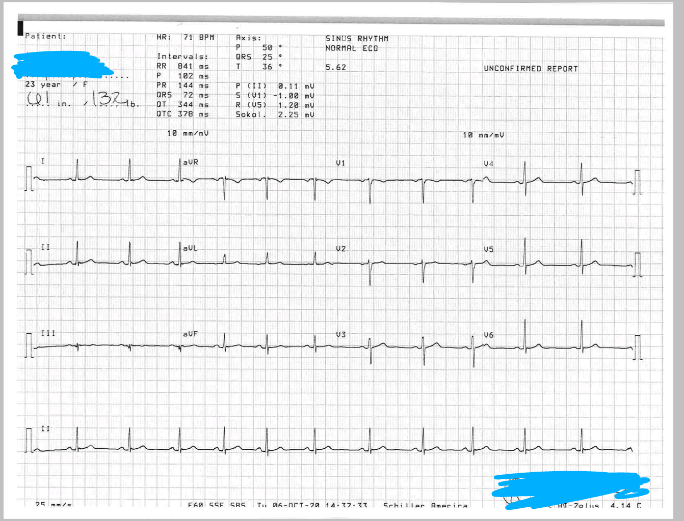 A second opinion on my EKG? Been suffering from tachycardia and chest