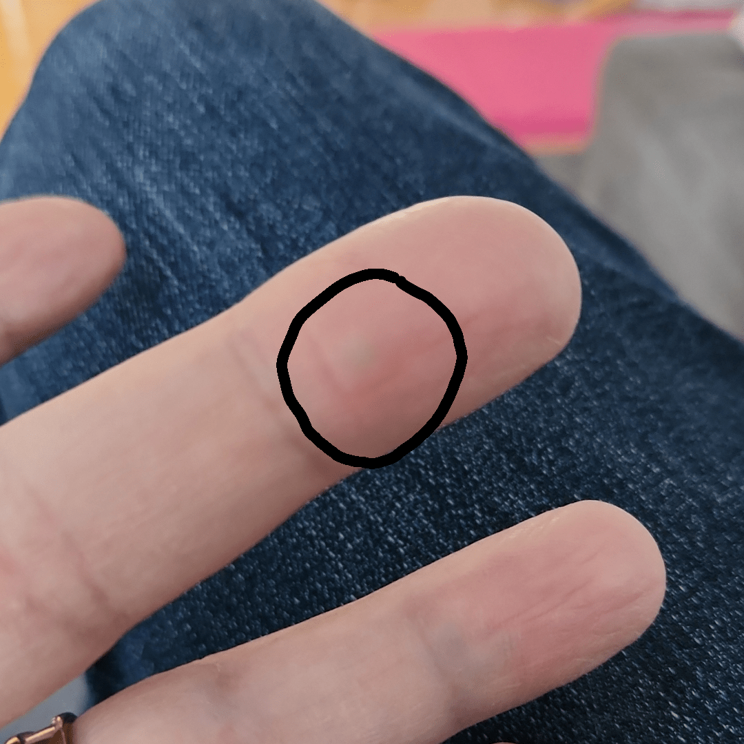 Bump on finger r/medical_advice
