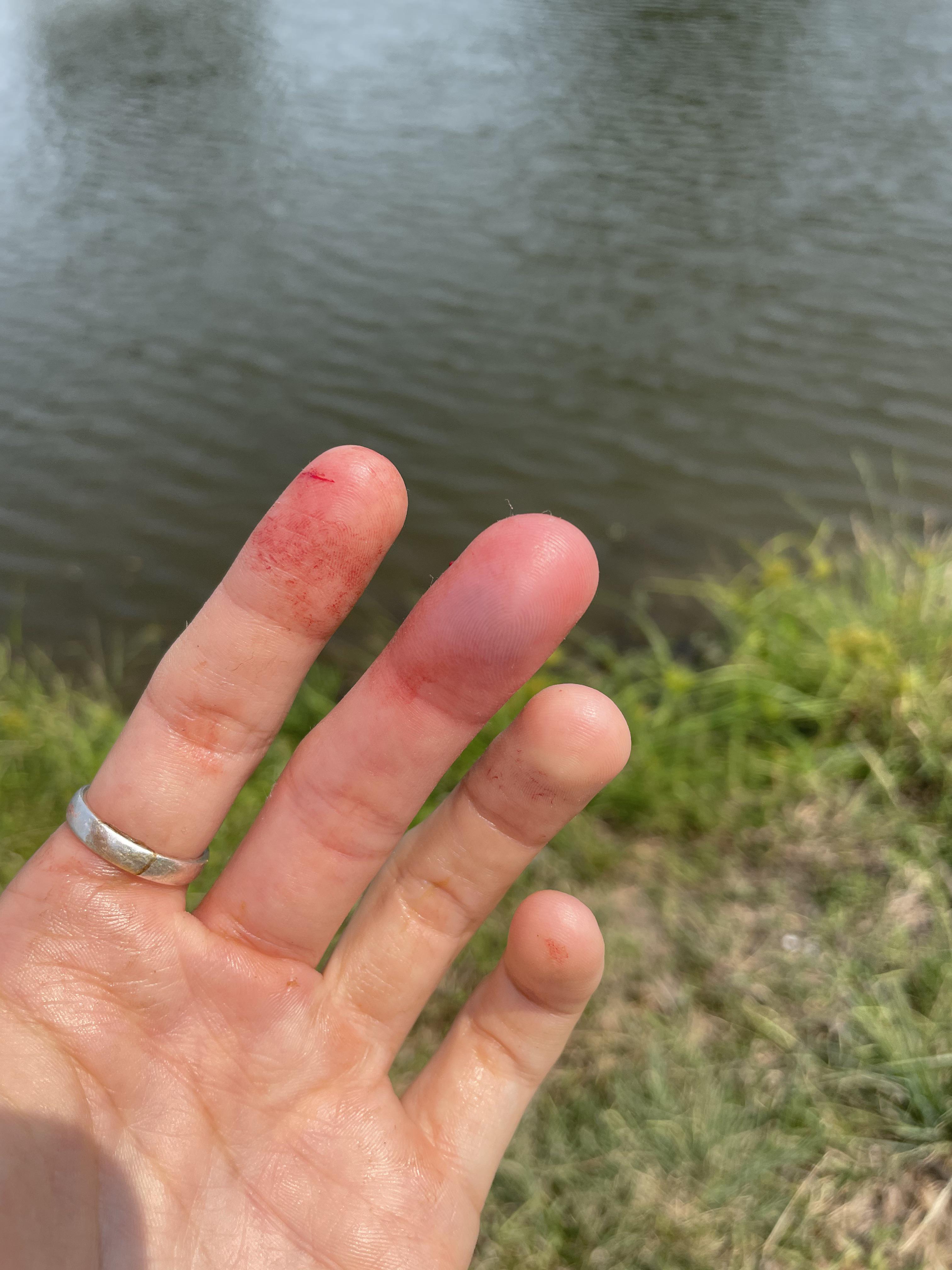 Saltwater Catfish Sting