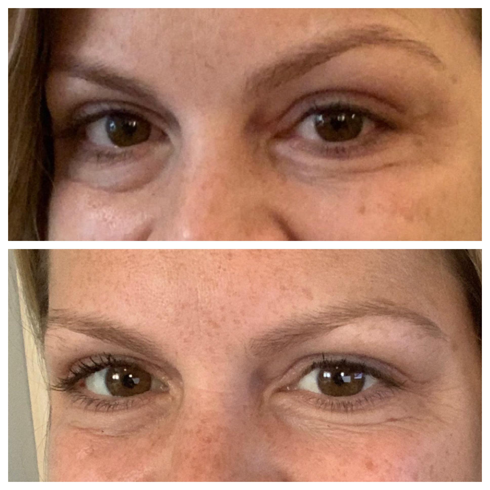 Under eye filler results before/after r/Skincare_Addiction