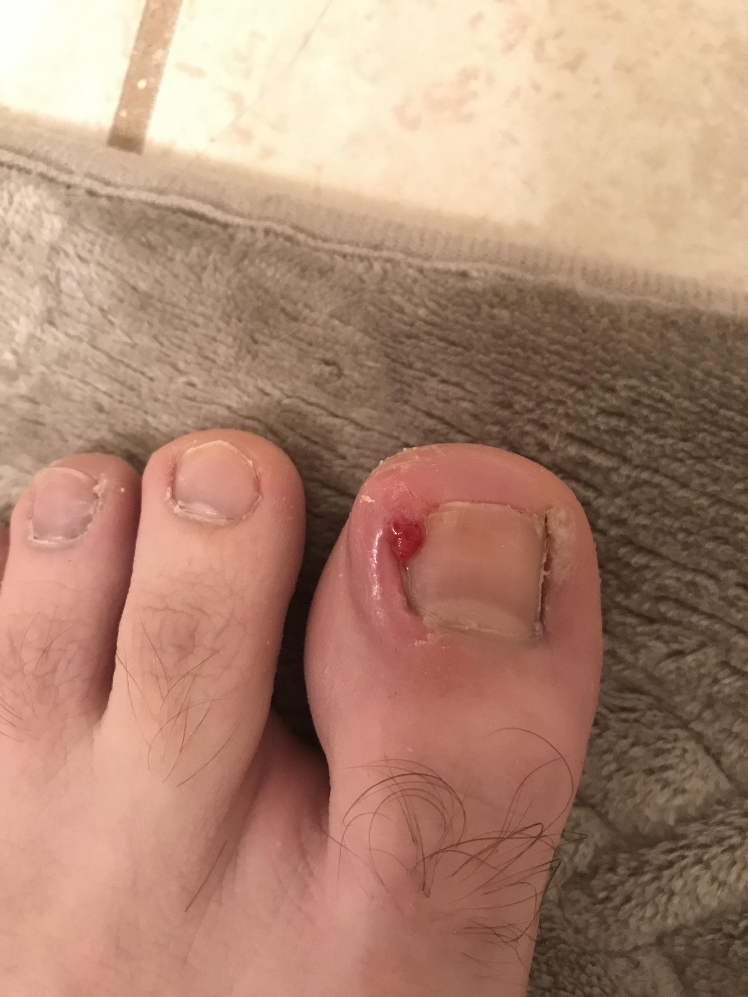 The skin growing over nail from ingrown toenail and is it bad enough to
