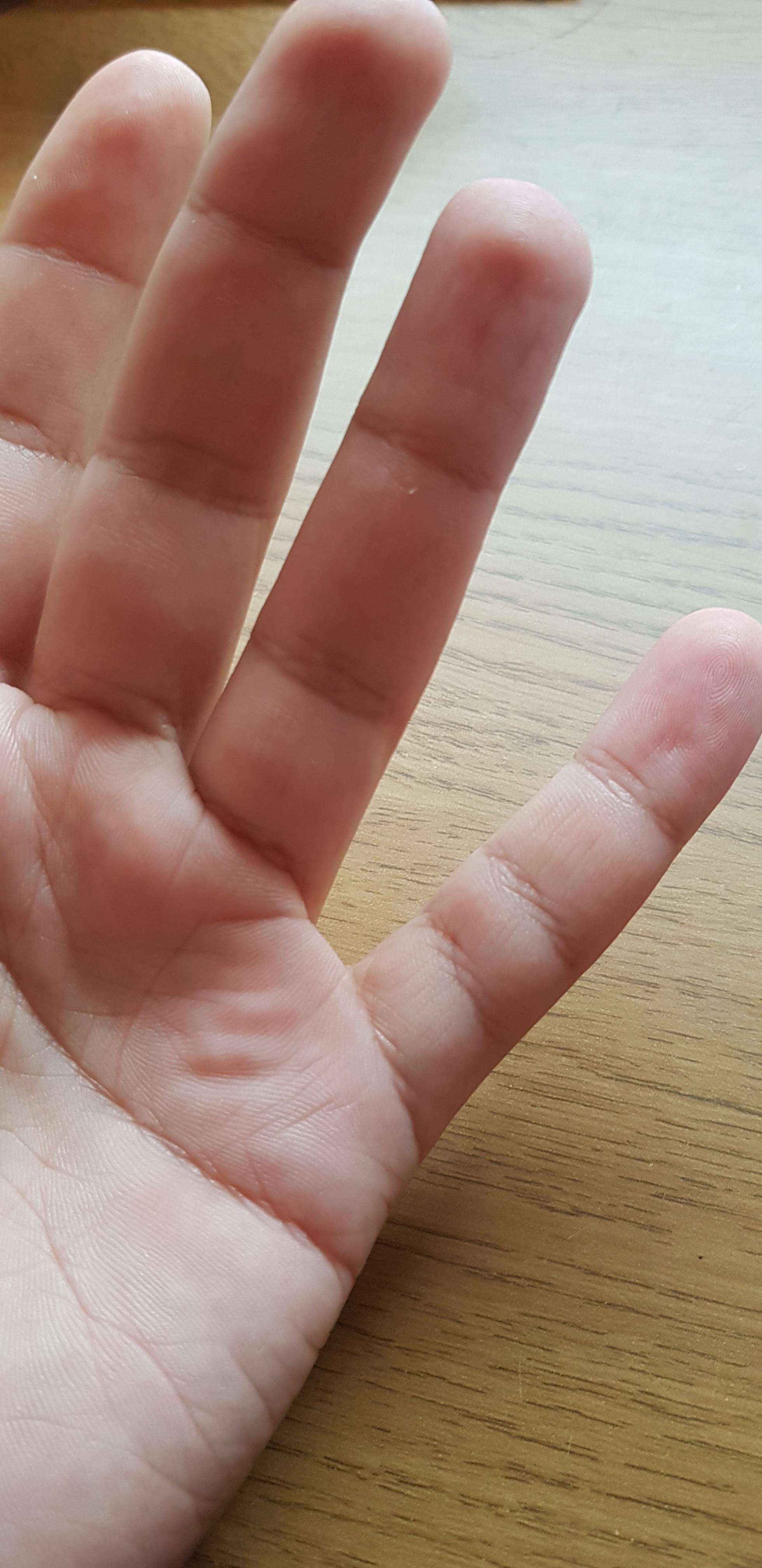 My left hand pinky finger has an extra joint crease but no extra joint
