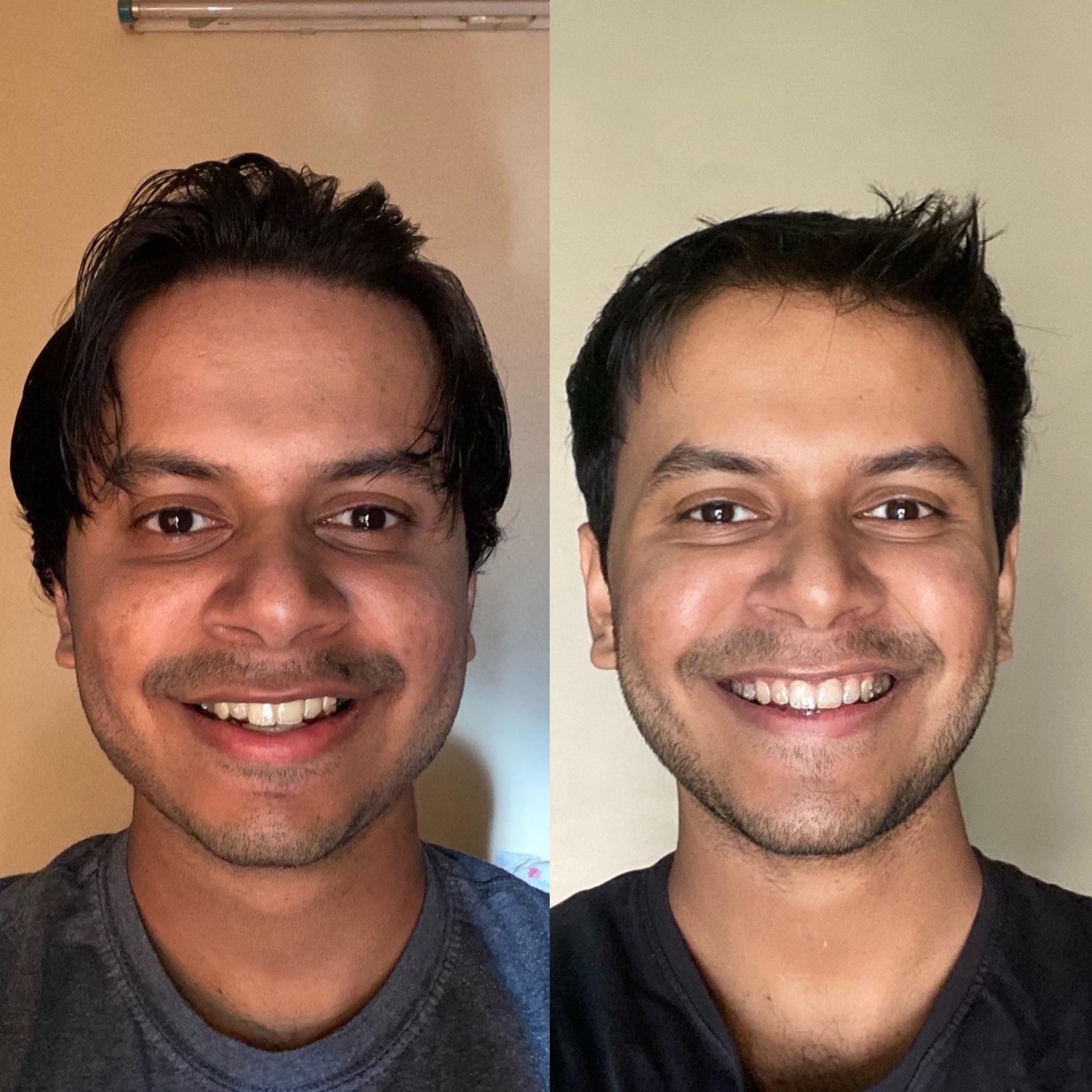 How To Fix An Overbite Naturally Reddit Can Invisalign Fix Overbites