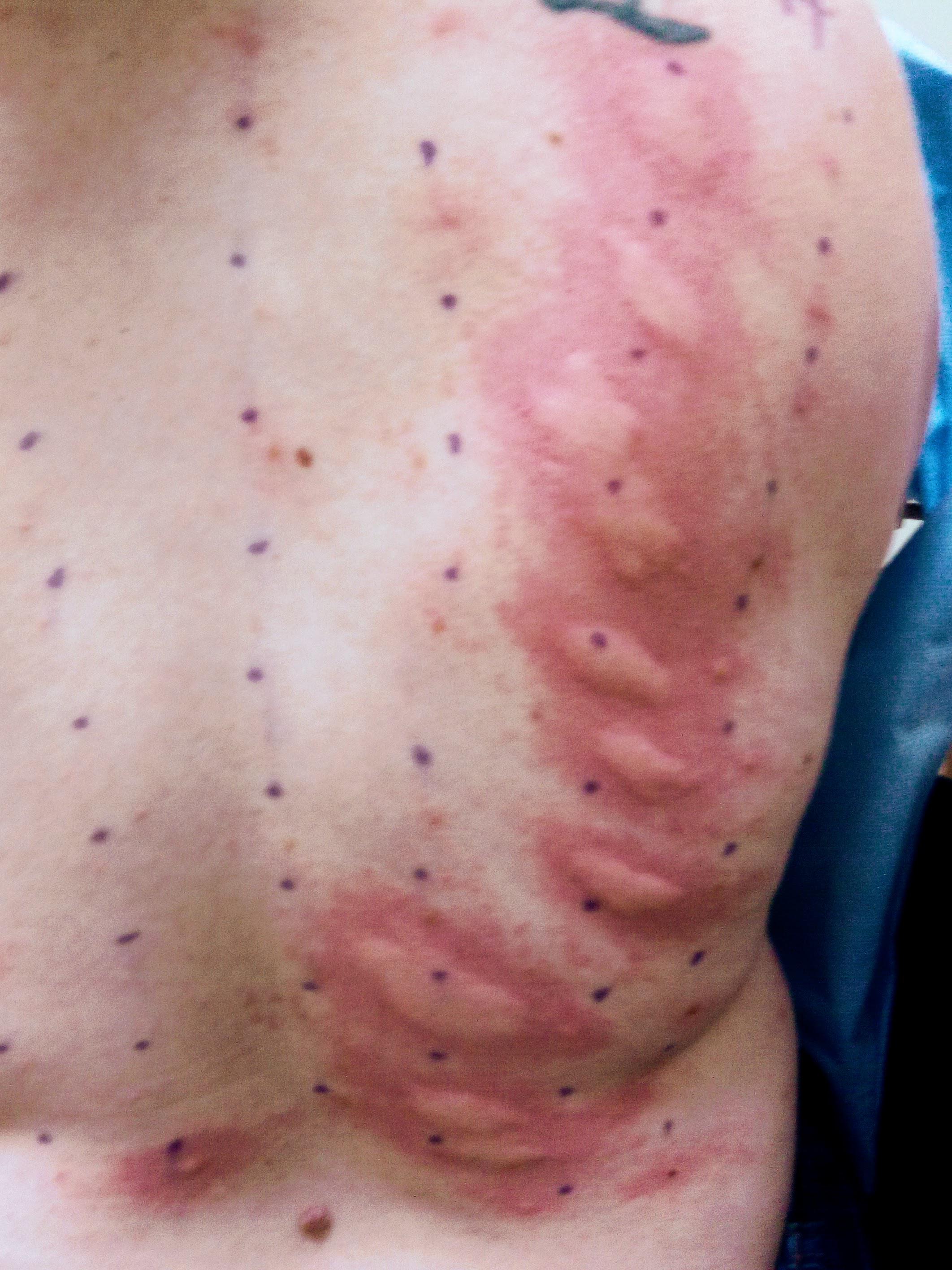 My first allergy test was last year, age 35. This diagnosis was totally