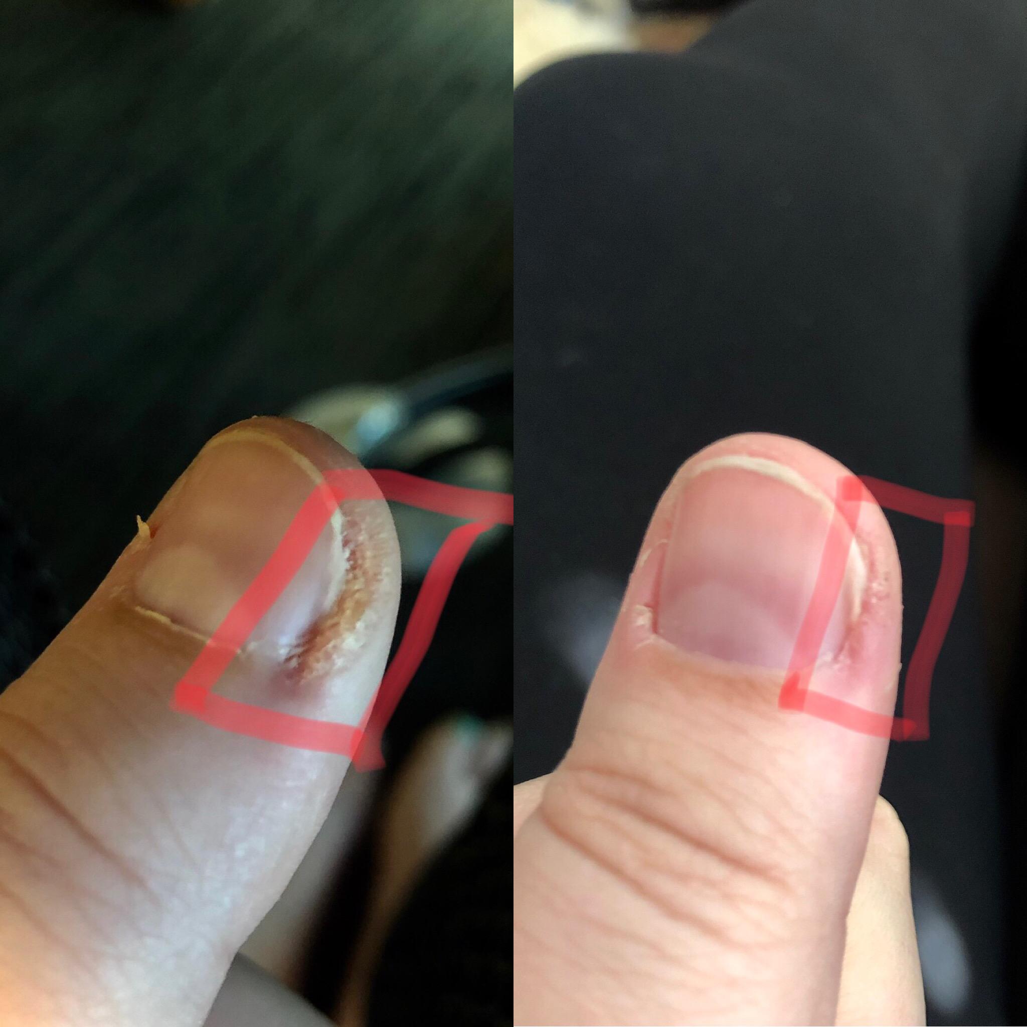 Result of a 72 hour fast on my periungual wart i've had for a year. I