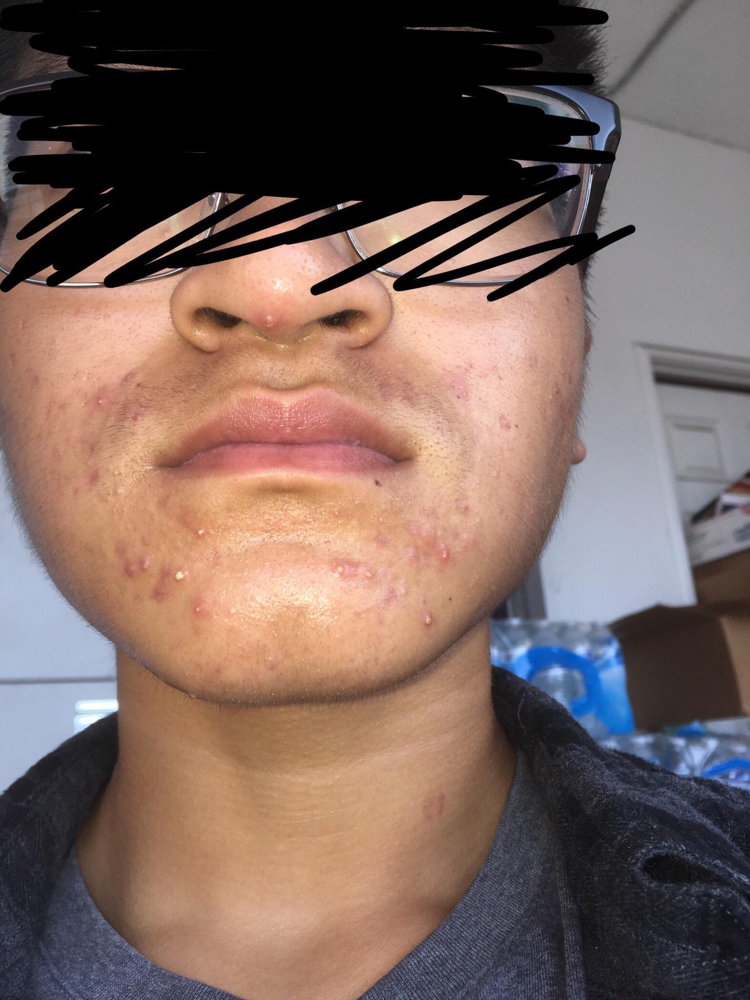 Have had acne for a year now and it keeps getting worse. Currently taking probiotics, zinc