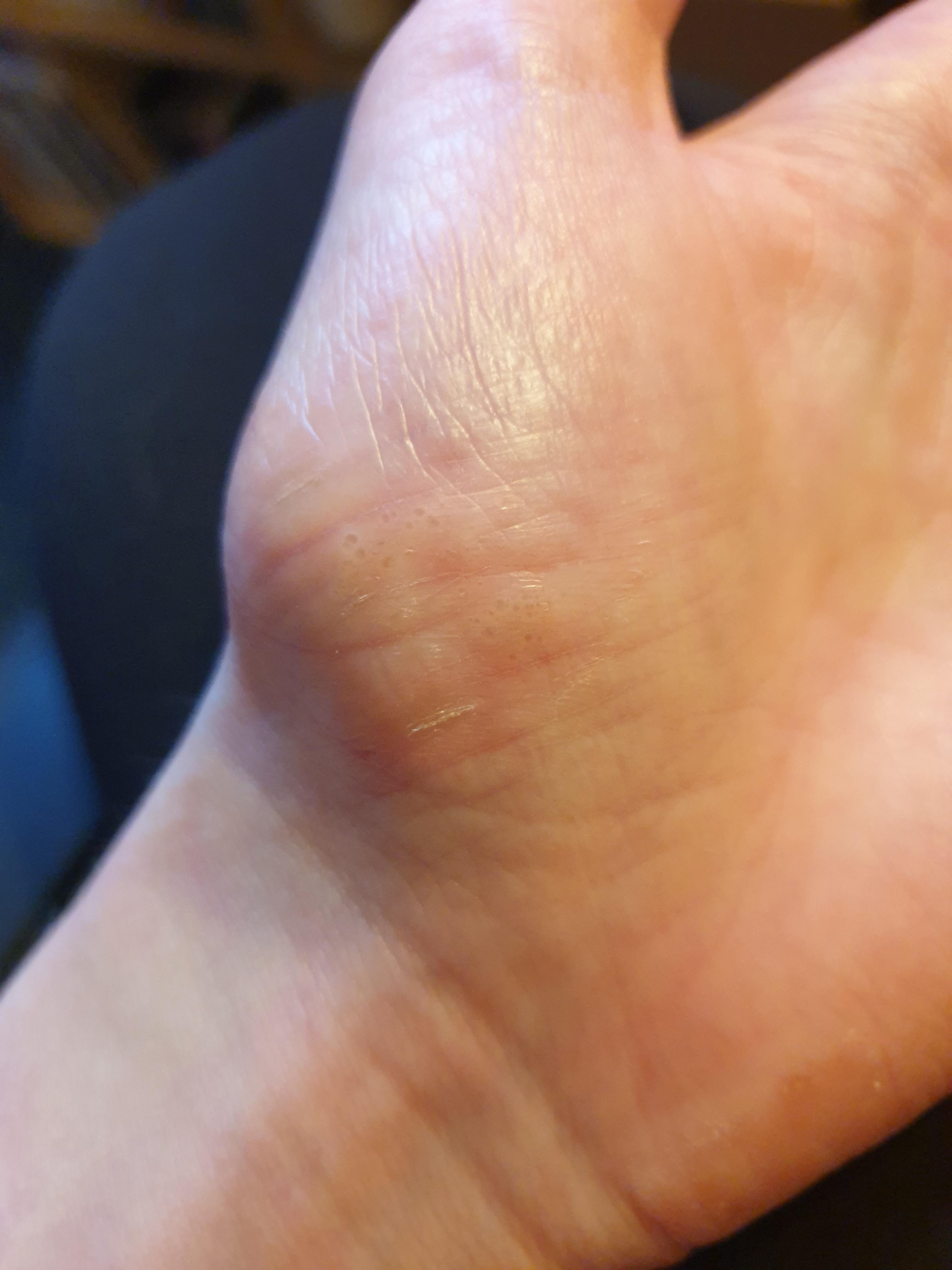 Mild Eczema Knuckles