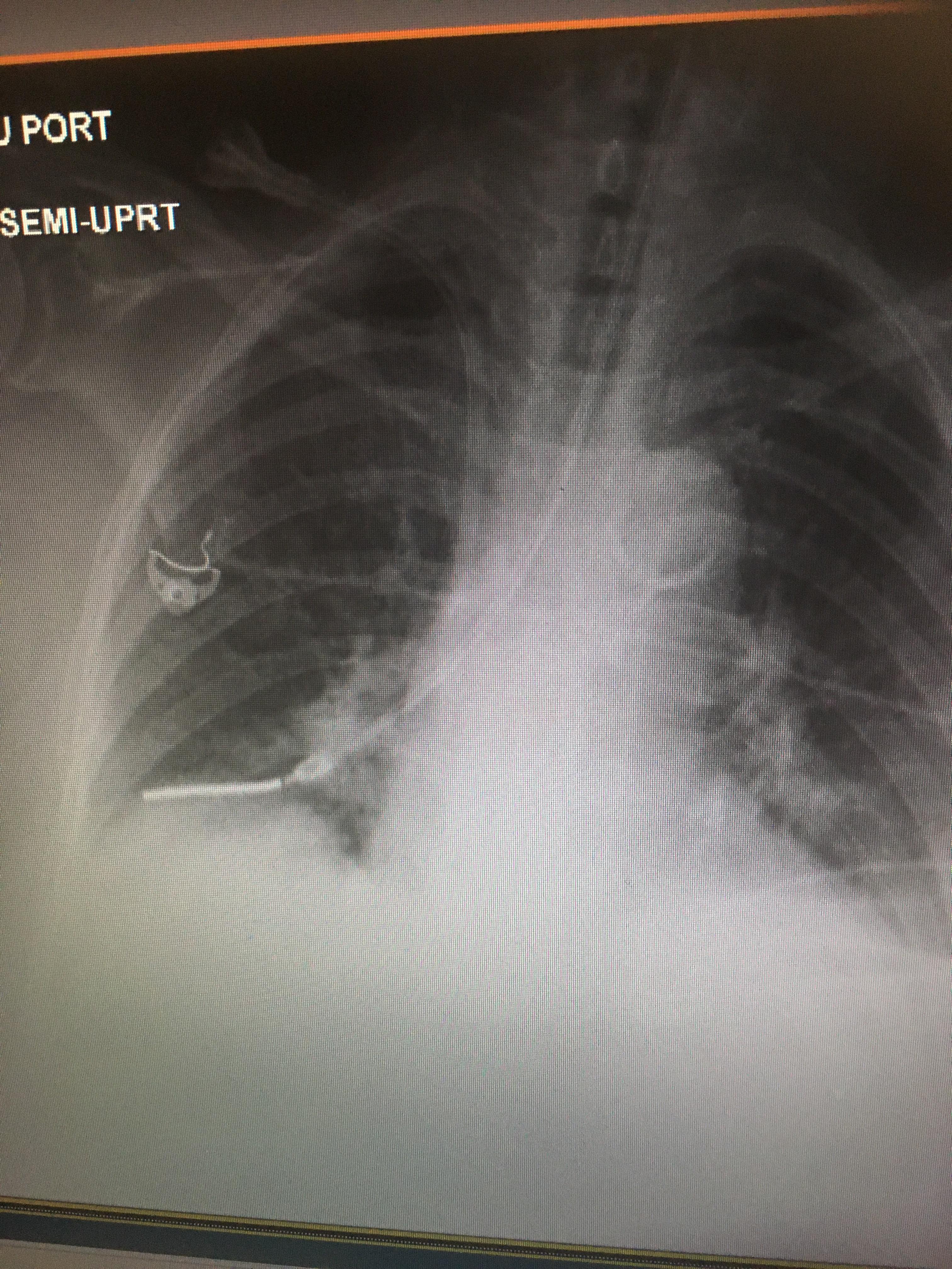 Xray confirmation of my duotube placement r/nursing