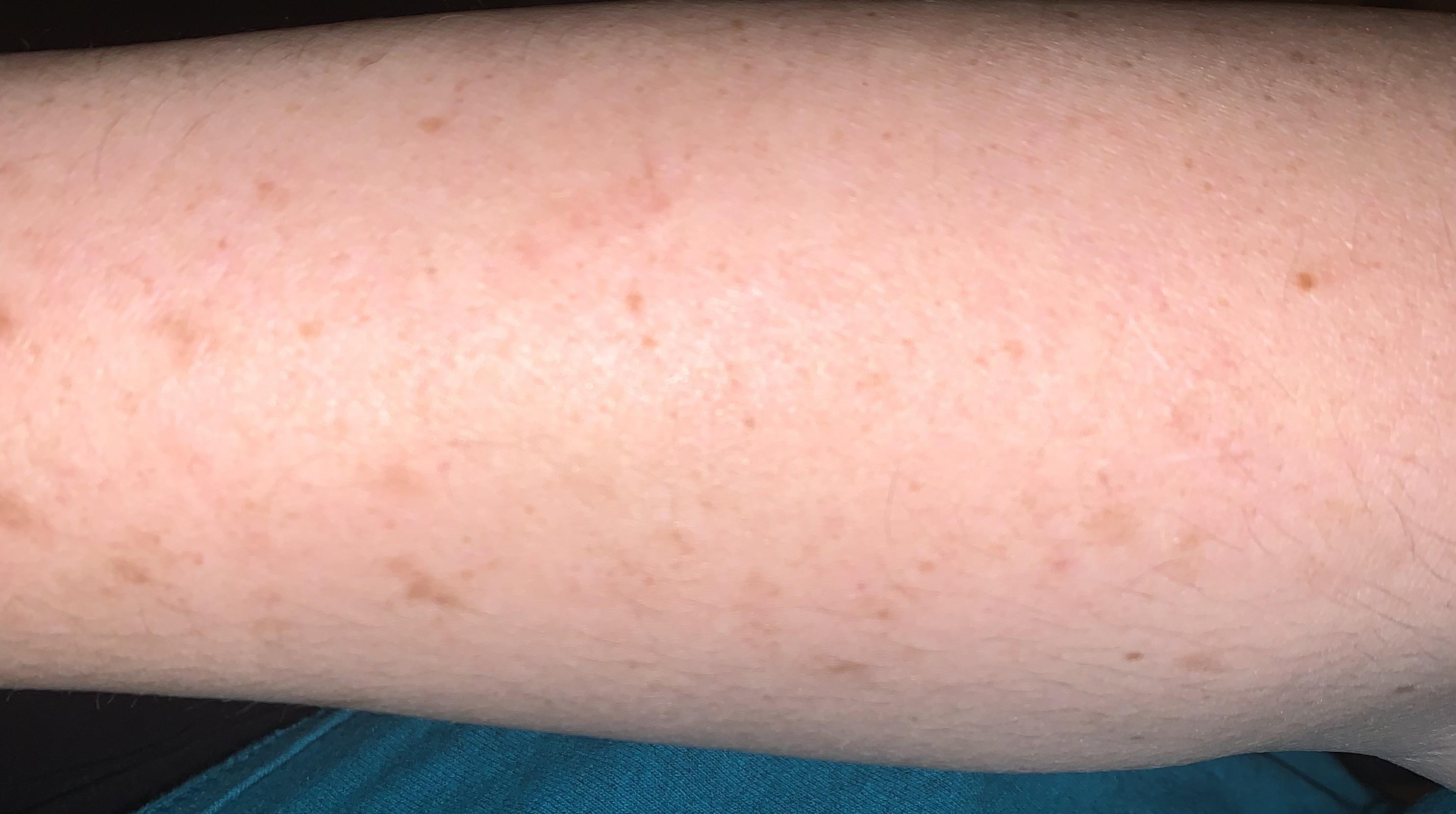 What can I use to get rid of these dark marks on my arms? They’ve been