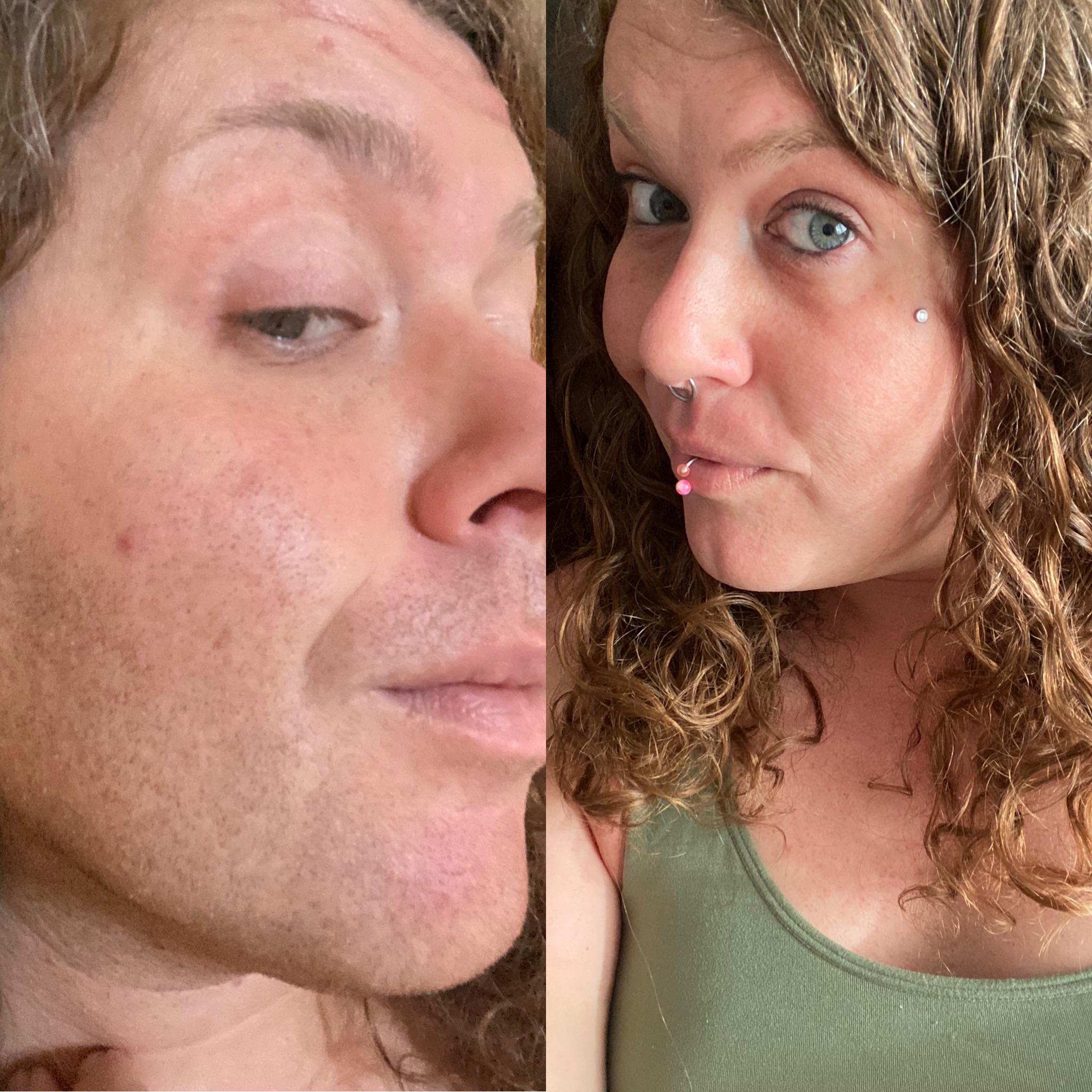 32yo MtF 6 months HRT w/ 6 treatments of laser hair removal r