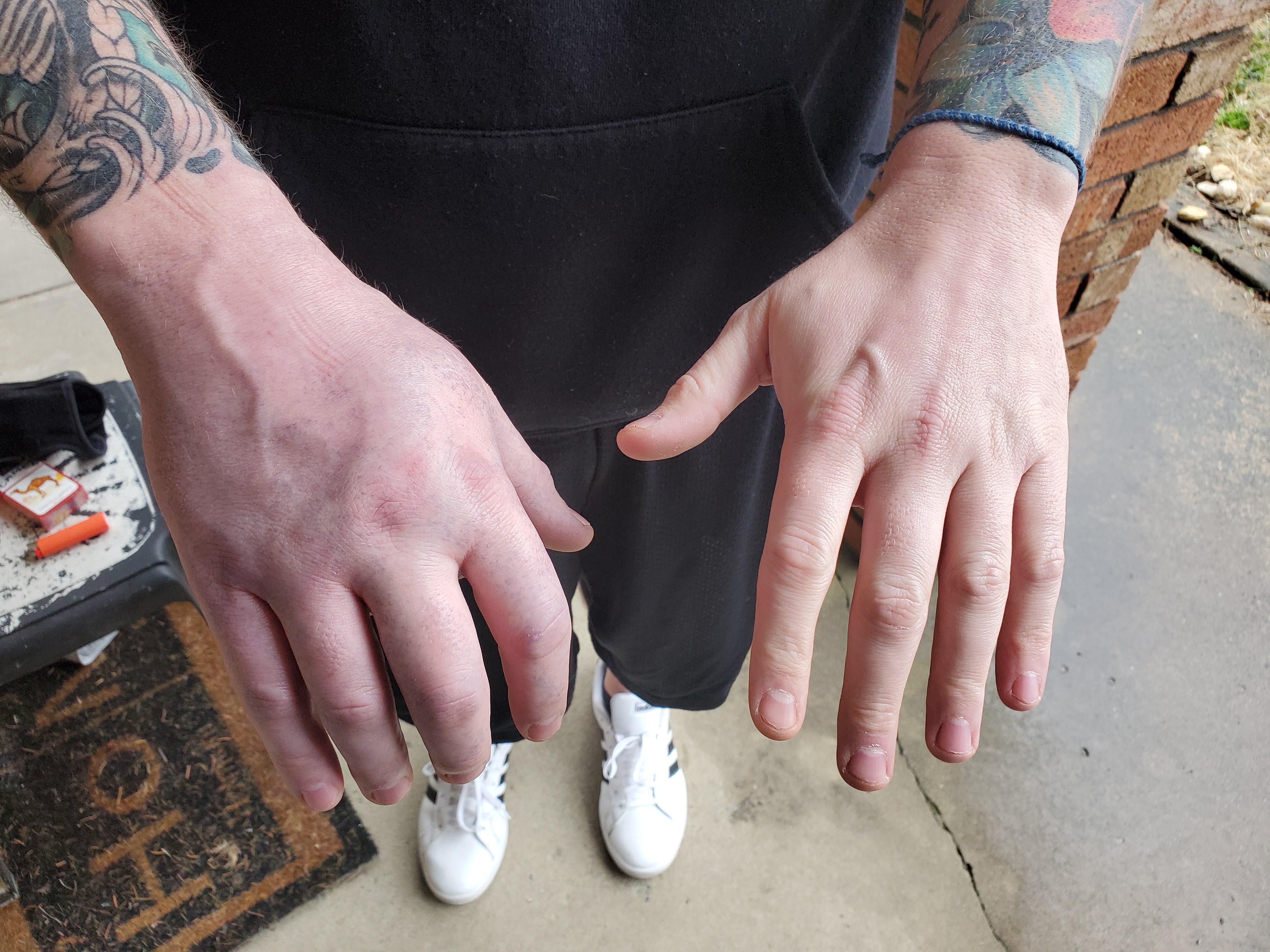 After dropping a 150 lb manhole lid on my hand completely crushing it