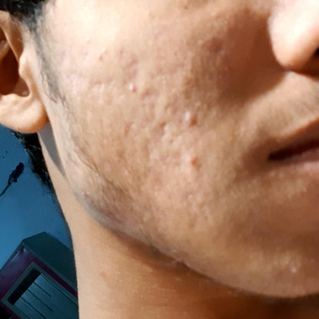 I have acne scars and redness.What should I do to treat them? r/acne