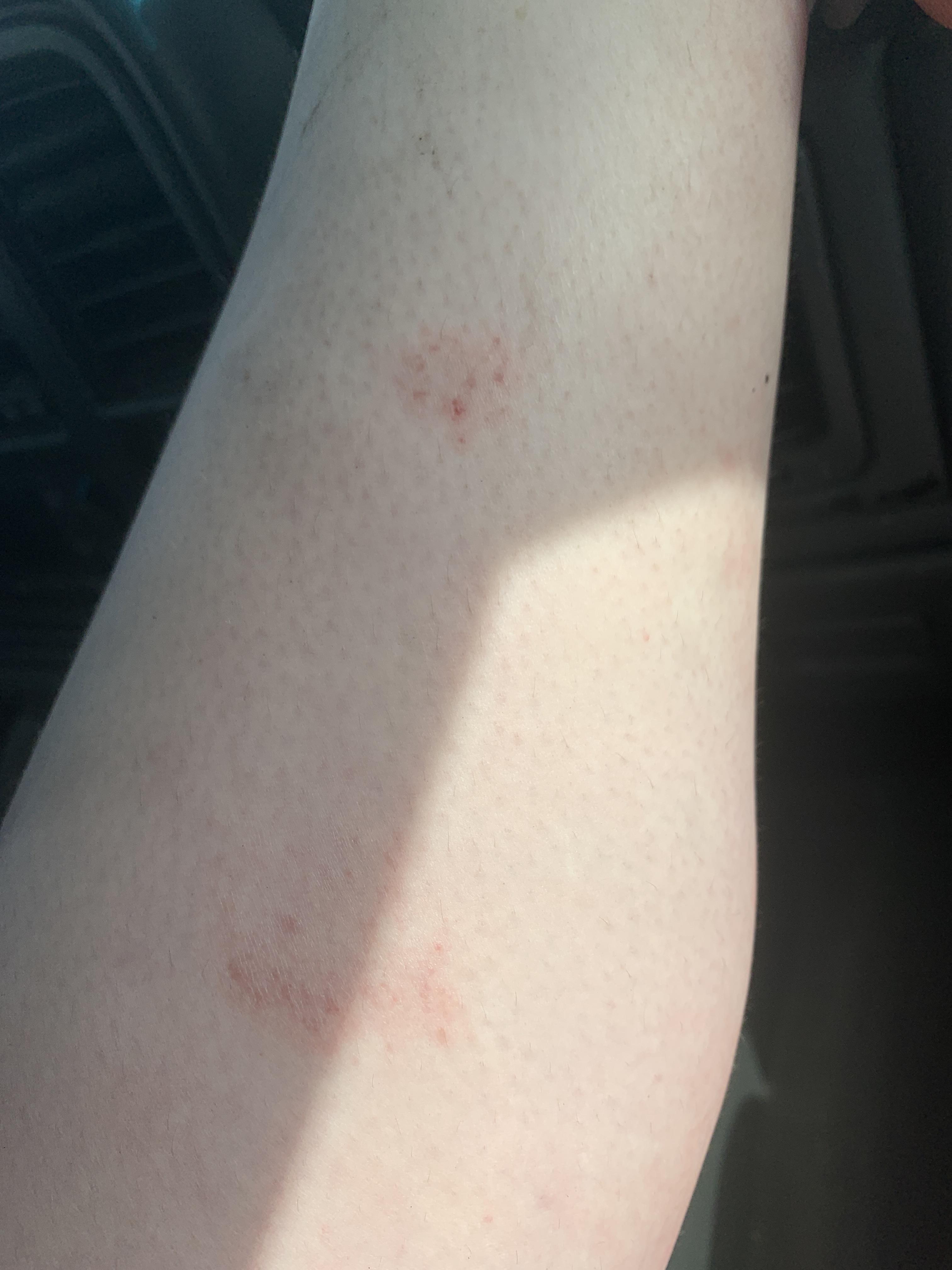 Red bumpy rash on arms and calves. This is on my calf and idk what it