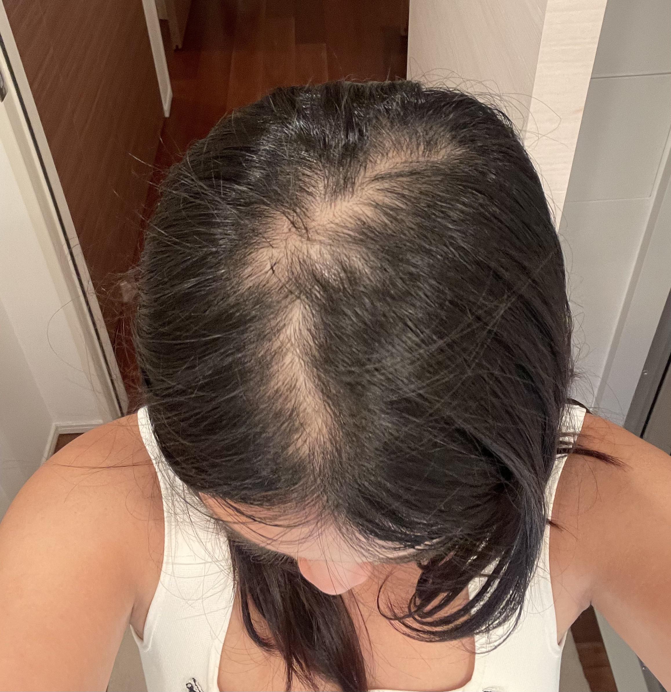 Hair loss r/Hairloss