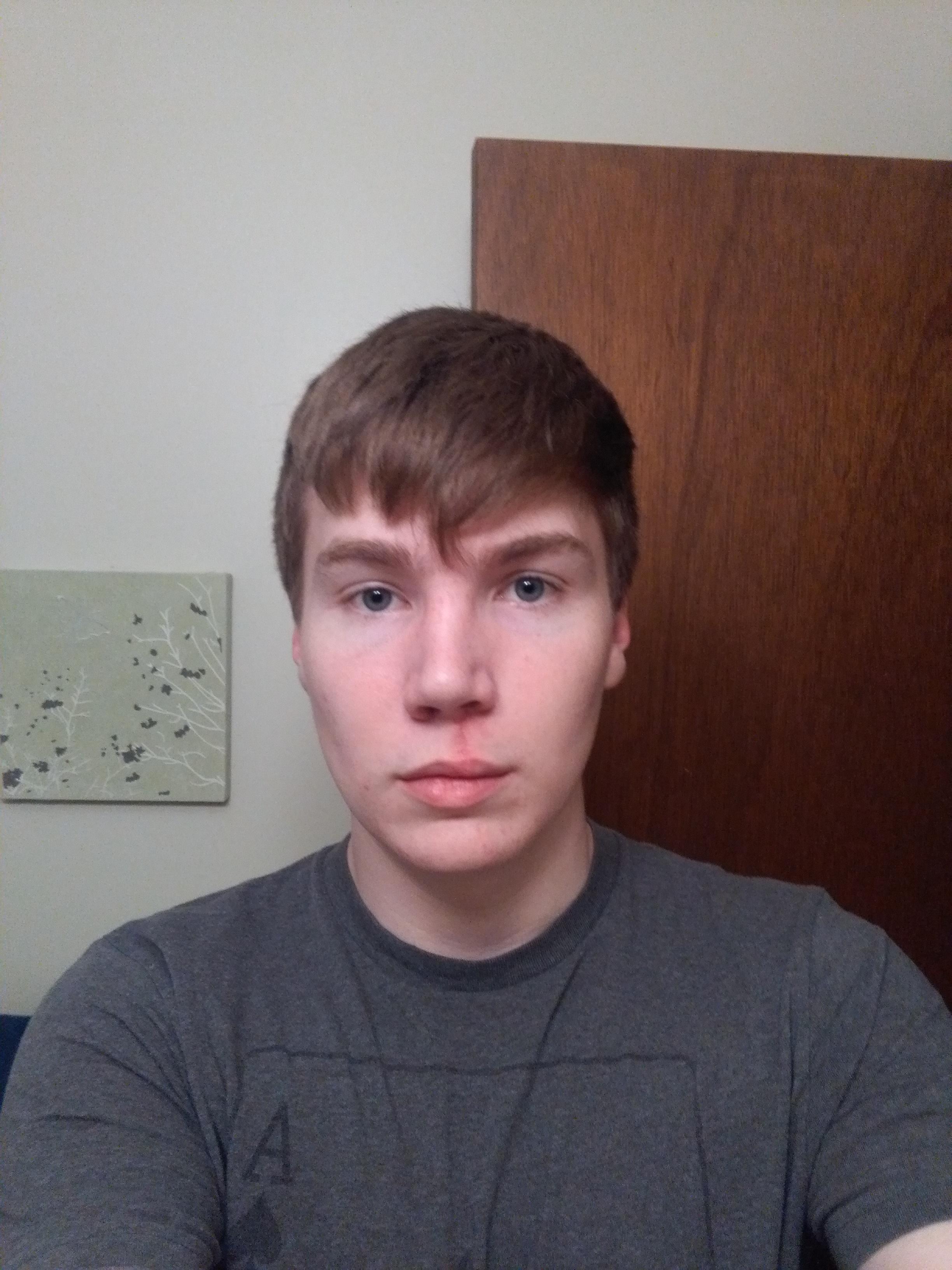 Cleft Lip Septoplasty w Cleft Lip Repair After 4 Months r/cleftlip