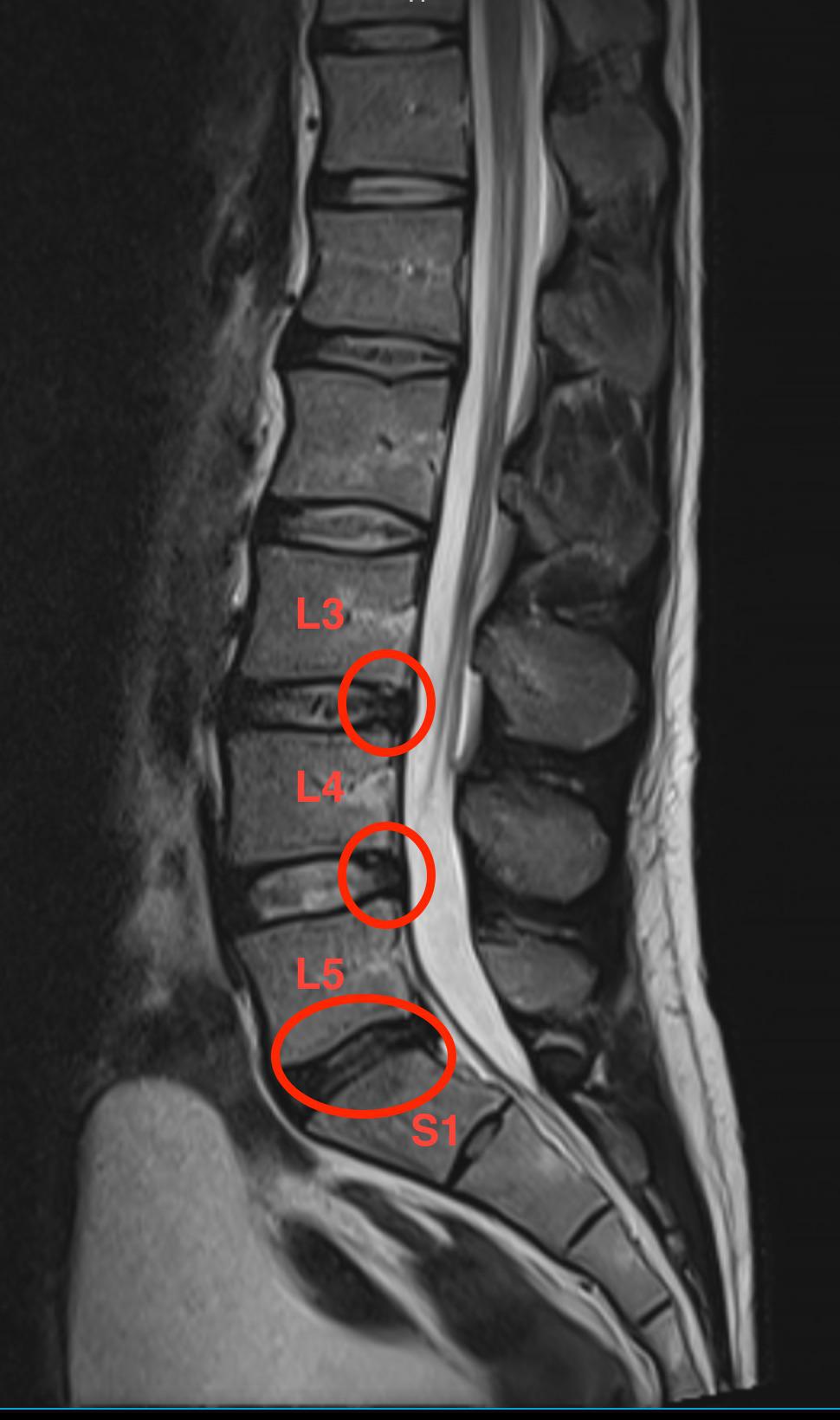 29yo, MRI showed L3L4 disk herniation and L5S1 desiccation. It has
