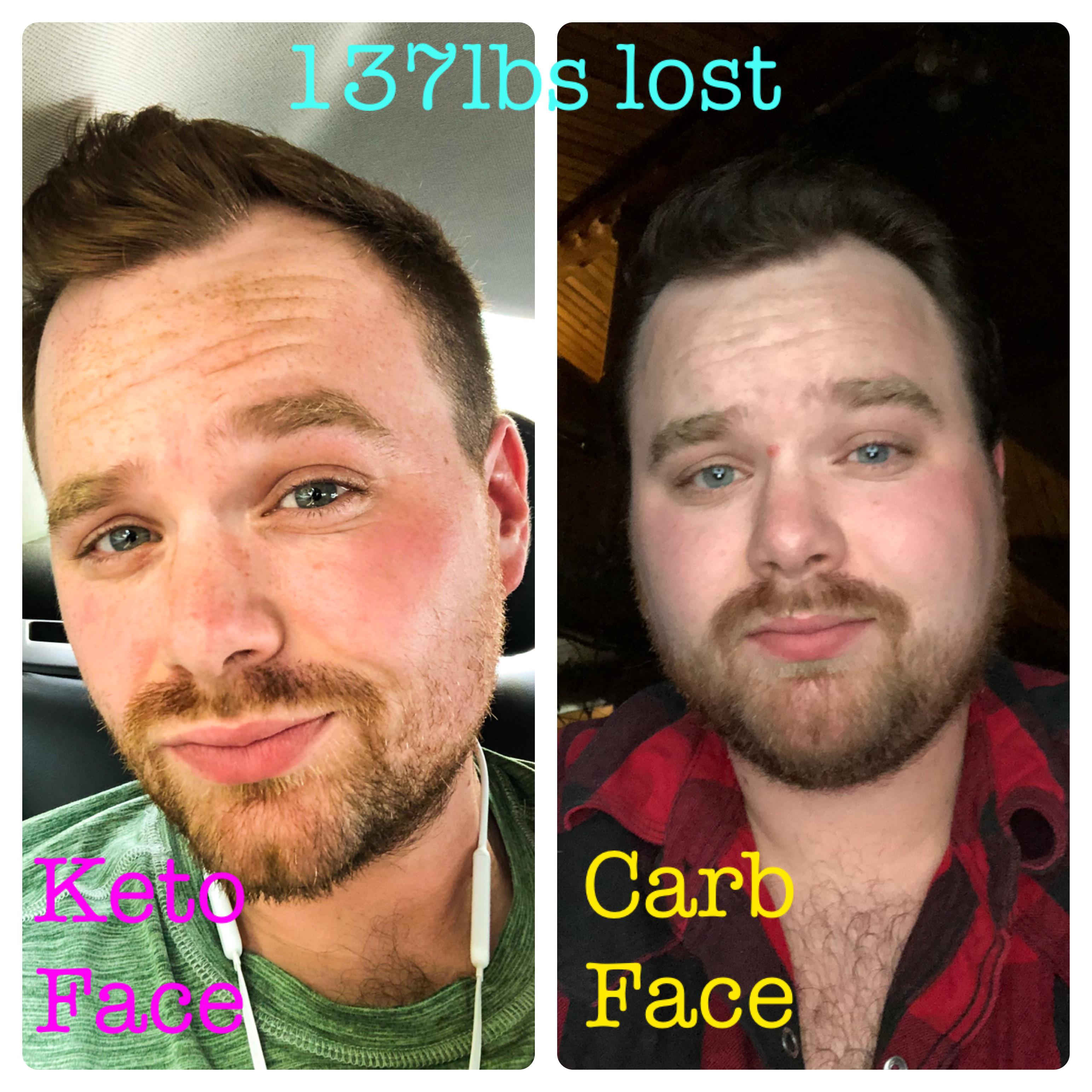 M/29/5’10” [337lbs > 200lbs = 137lbs] (14 months) Strict keto for 6 months, low carb the rest