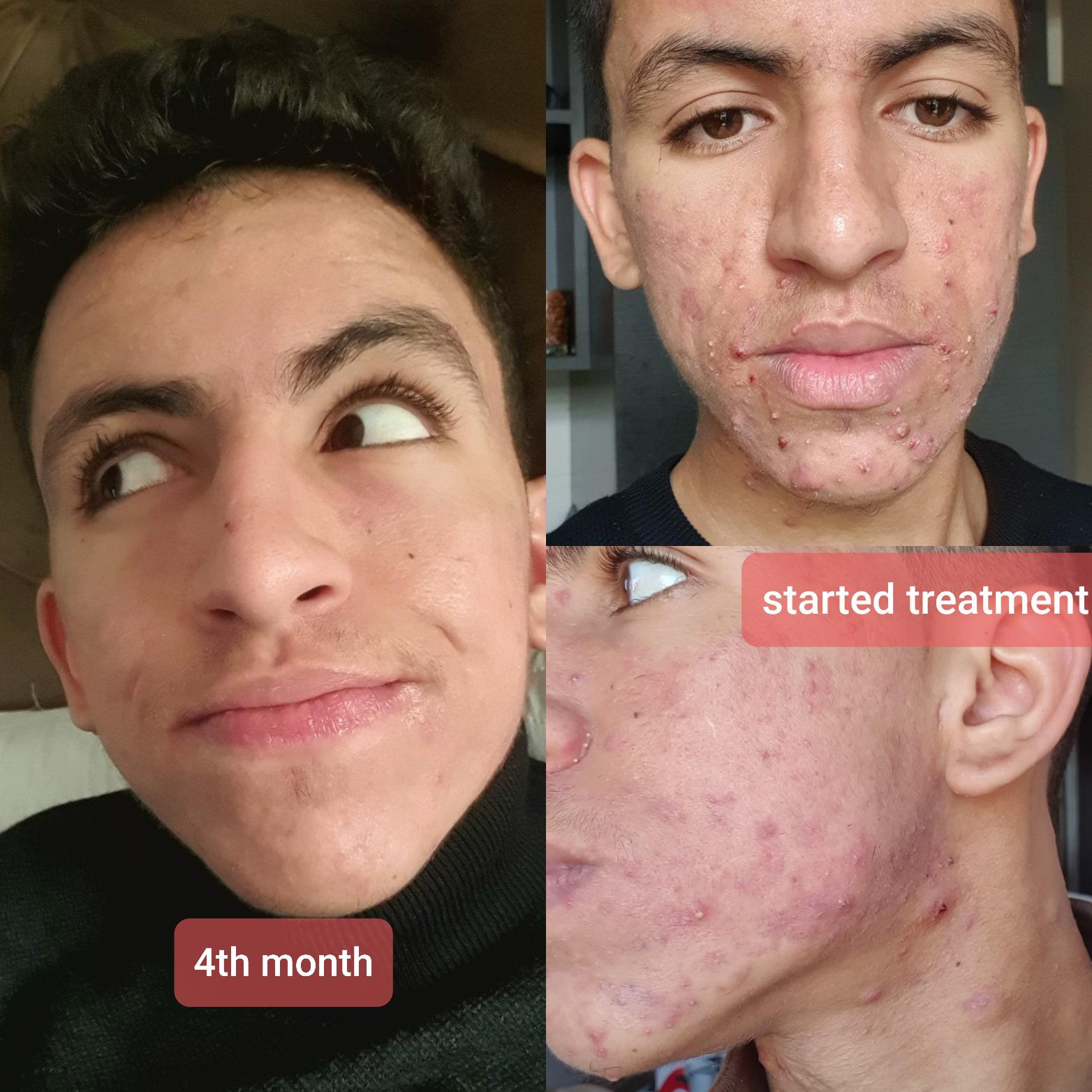 4th Month on Accutane. Huge change, But I've some scars, However, I'm
