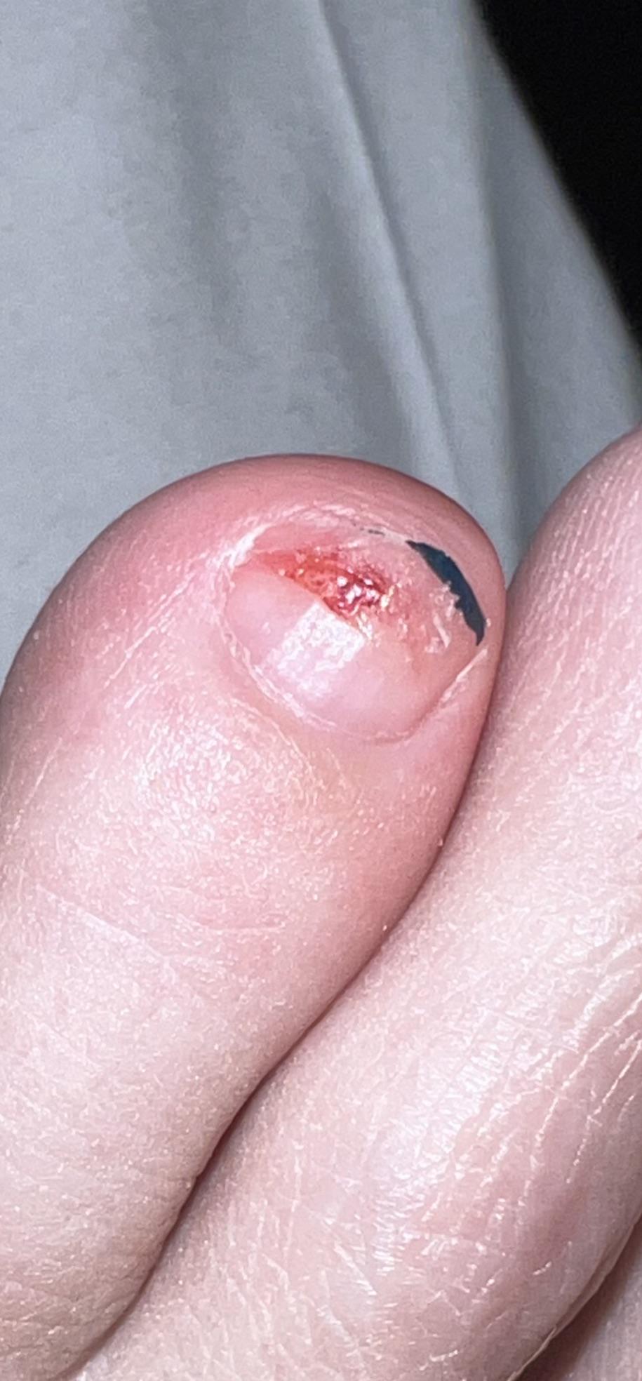 Swimming with Toe Nail Injury? r/Swimming