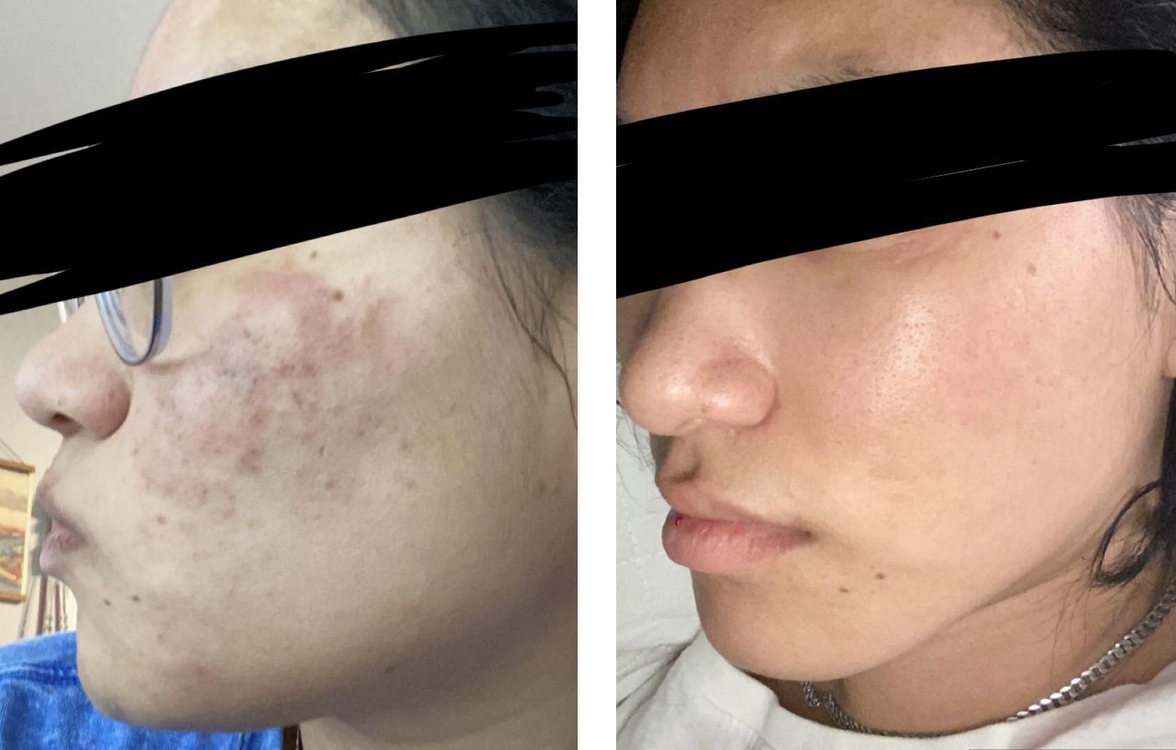 Before and after 1540 laser treatments for rosacea and acne scarring. So happy with the