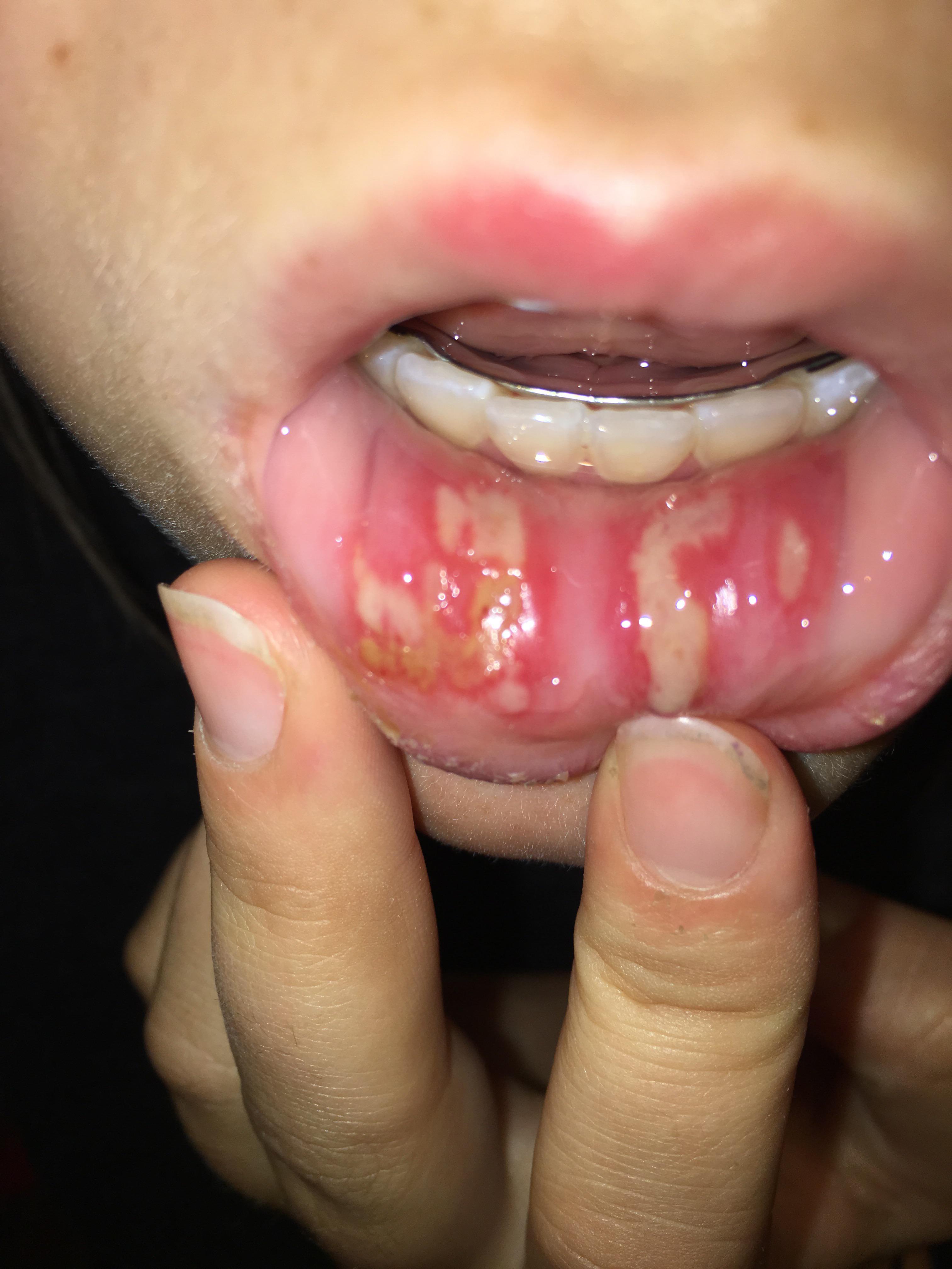 Aphthous Ulcerations (Canker Sores) DERMBOARD, 48 OFF