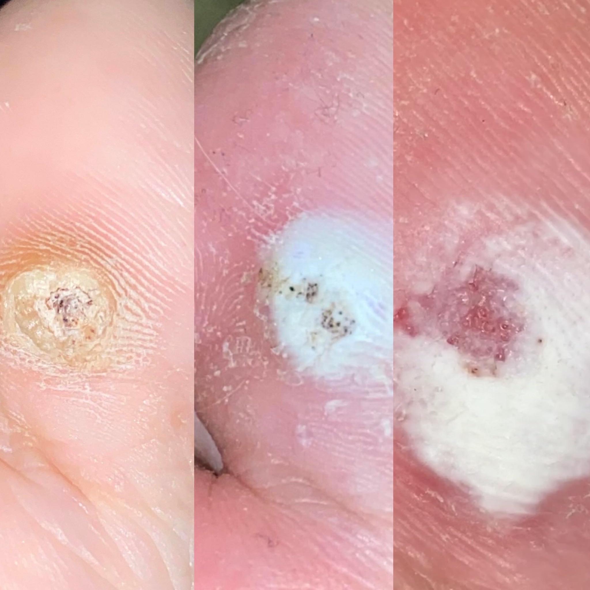 Is it going away?? I’ve been using compound w for 3 weeks now 😭 r/Warts