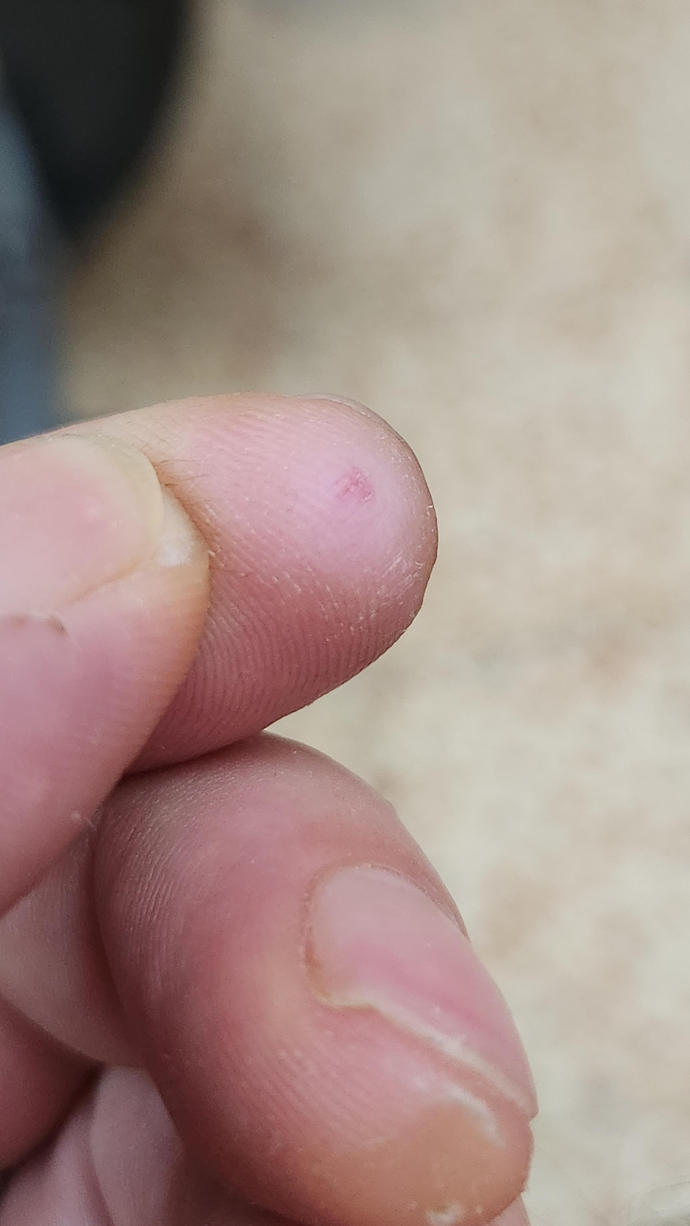 I grinded away my callus cause of intense sharp pain under it when