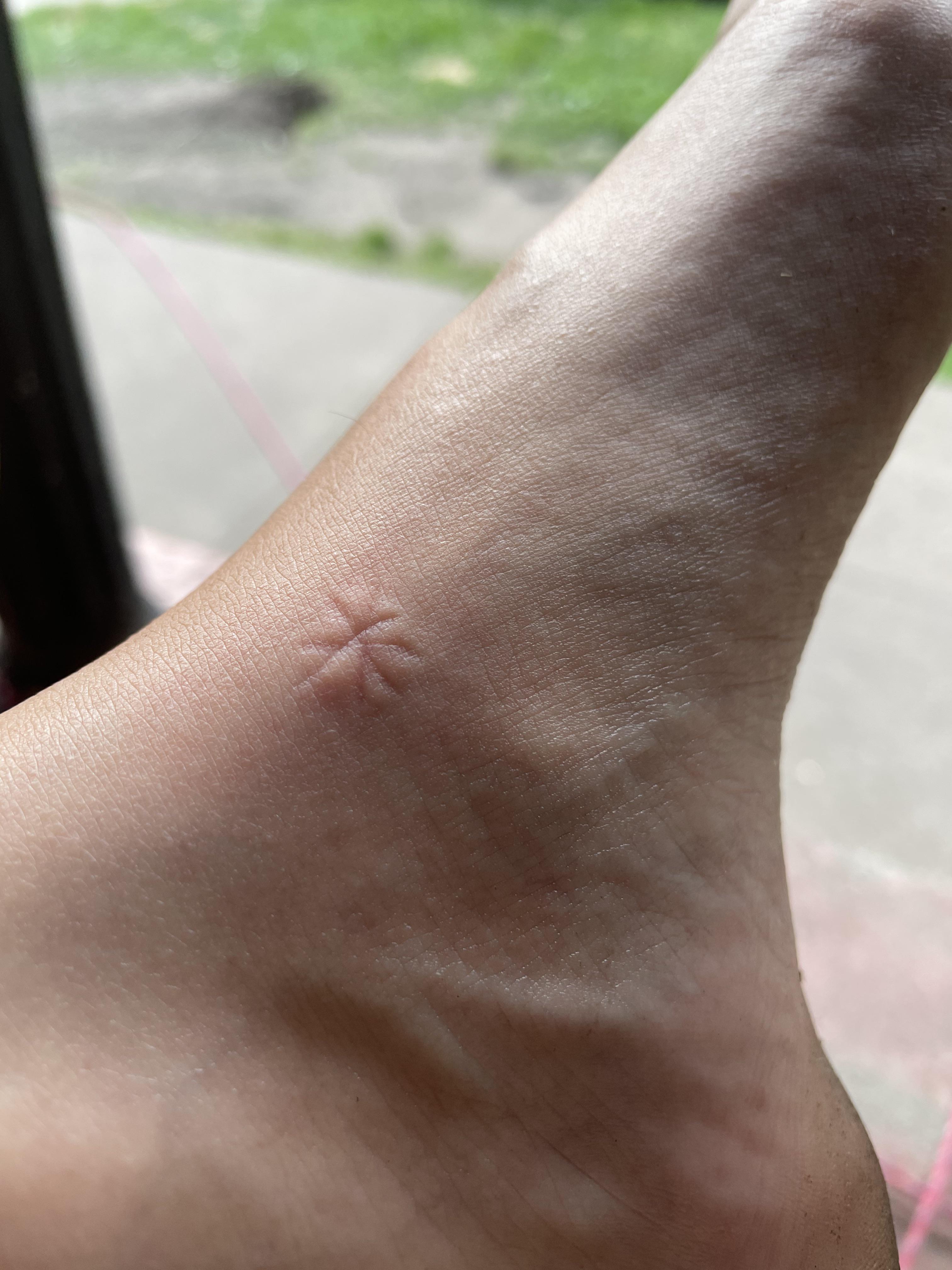 Dealing with mosquito bites like my mom taught me r/minnesota