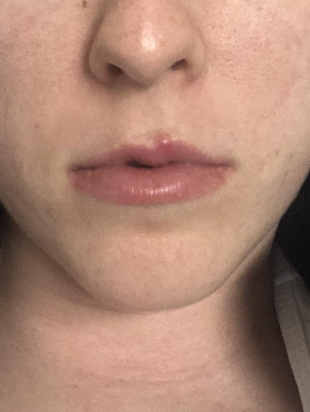[acne] Any advice for dealing with a pimple on your lips? (It’s taking