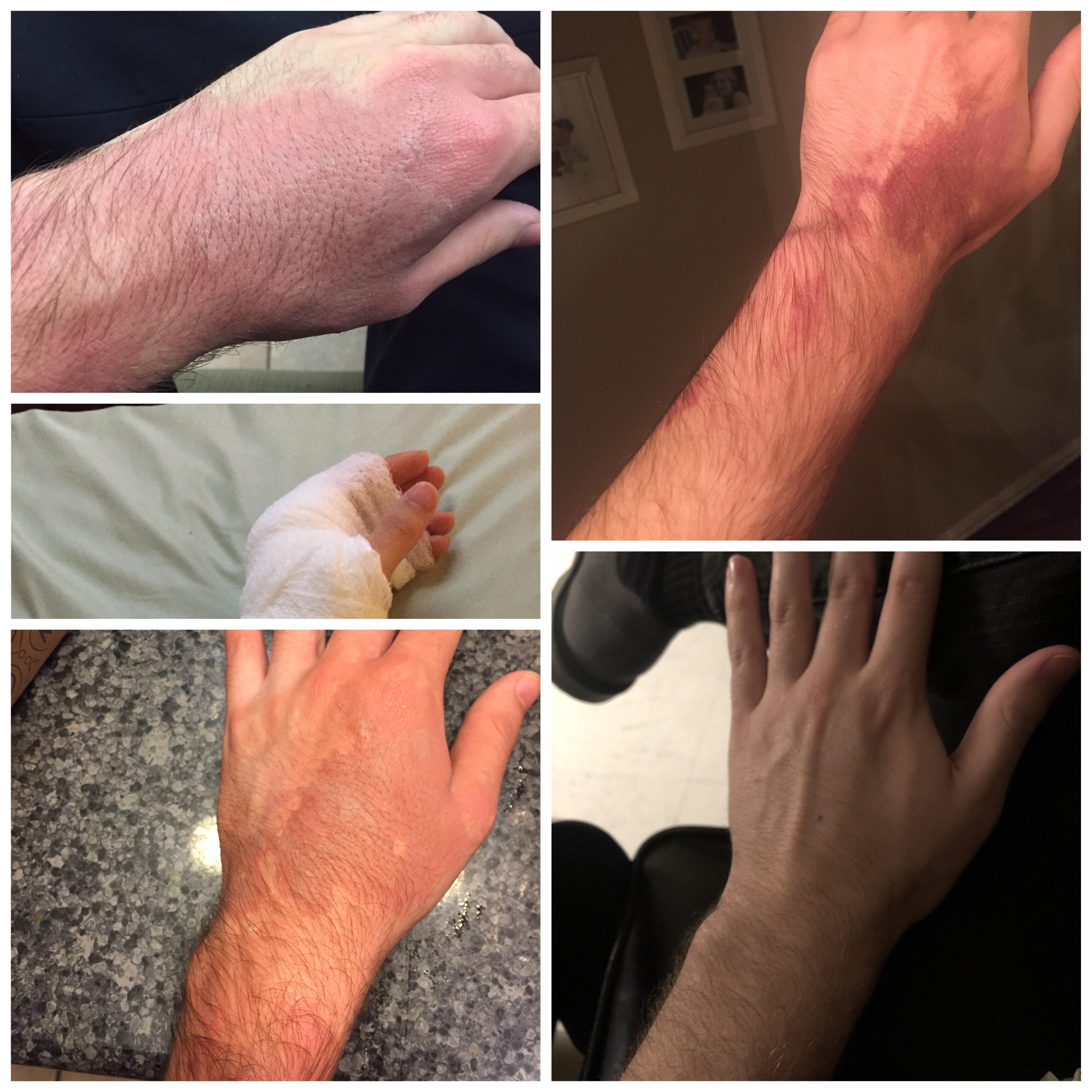 My grease burn full recovery ) r/KitchenConfidential