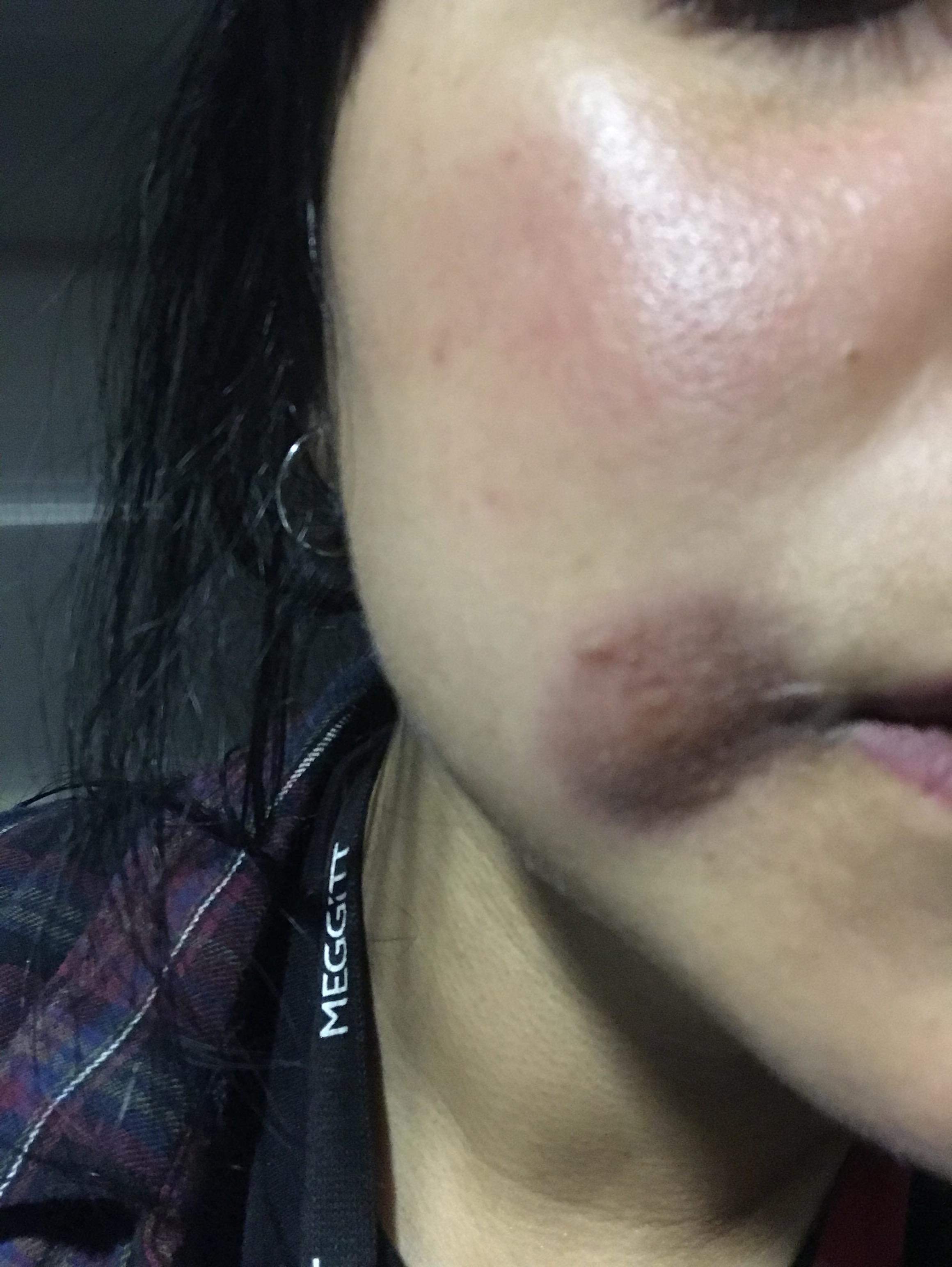 Fixed drug reaction/eruption. Can someone help me get lighten this? It