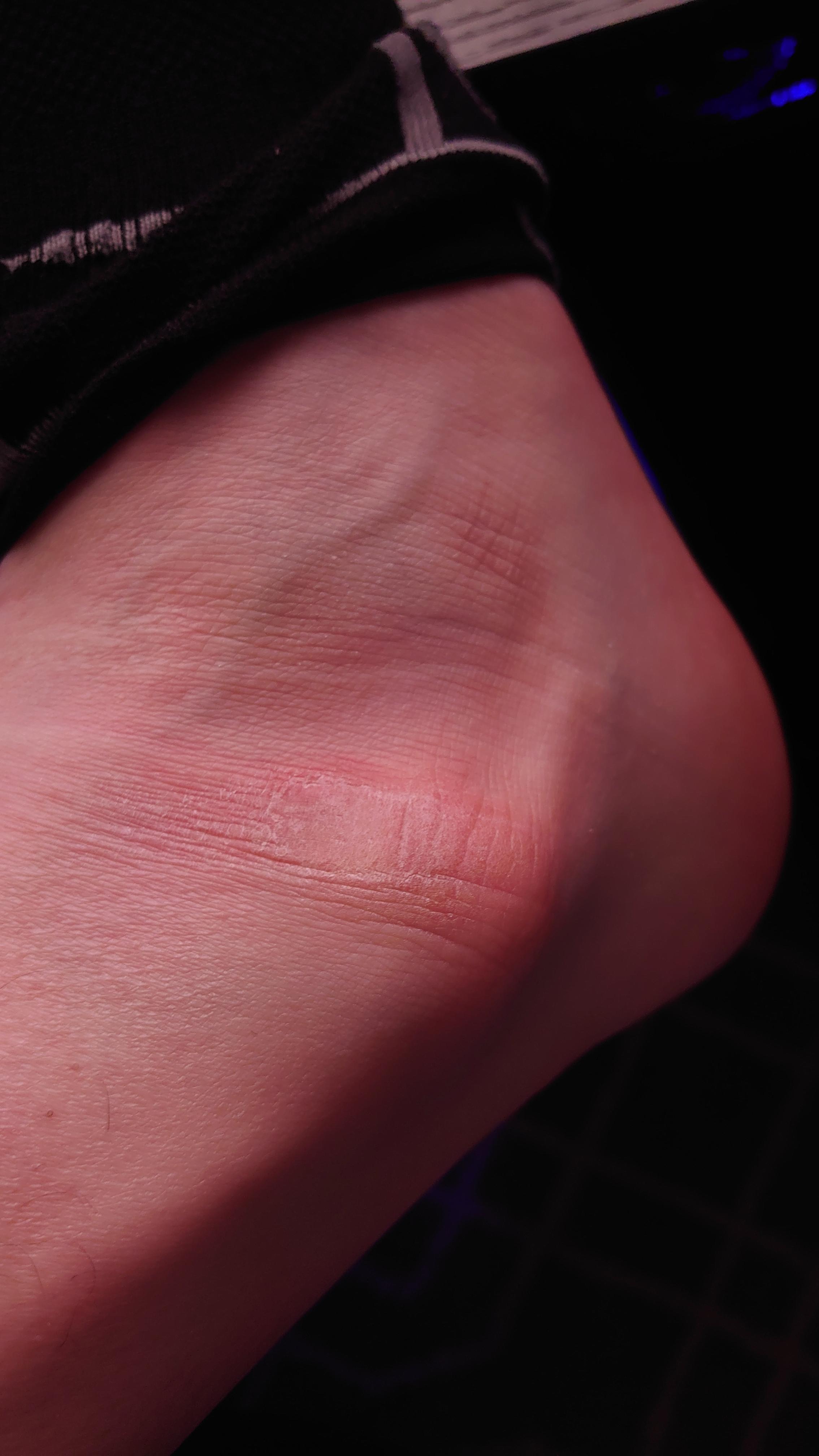 Just noticed ankle is getting really hard and leathery skin. I am looking for a lotion or