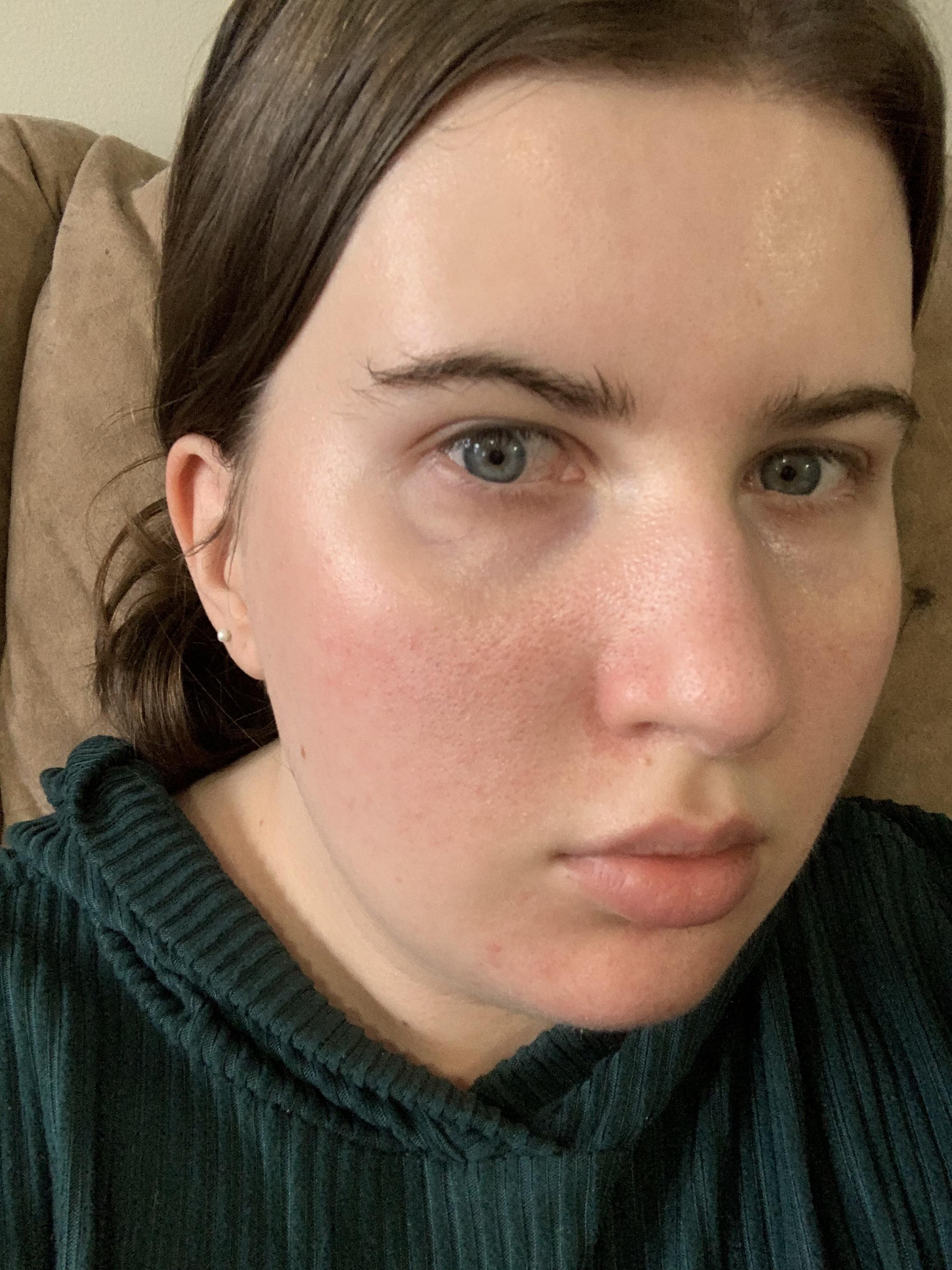 Is this just dry/dehydrated skin? Any product/ingredient suggestions? I