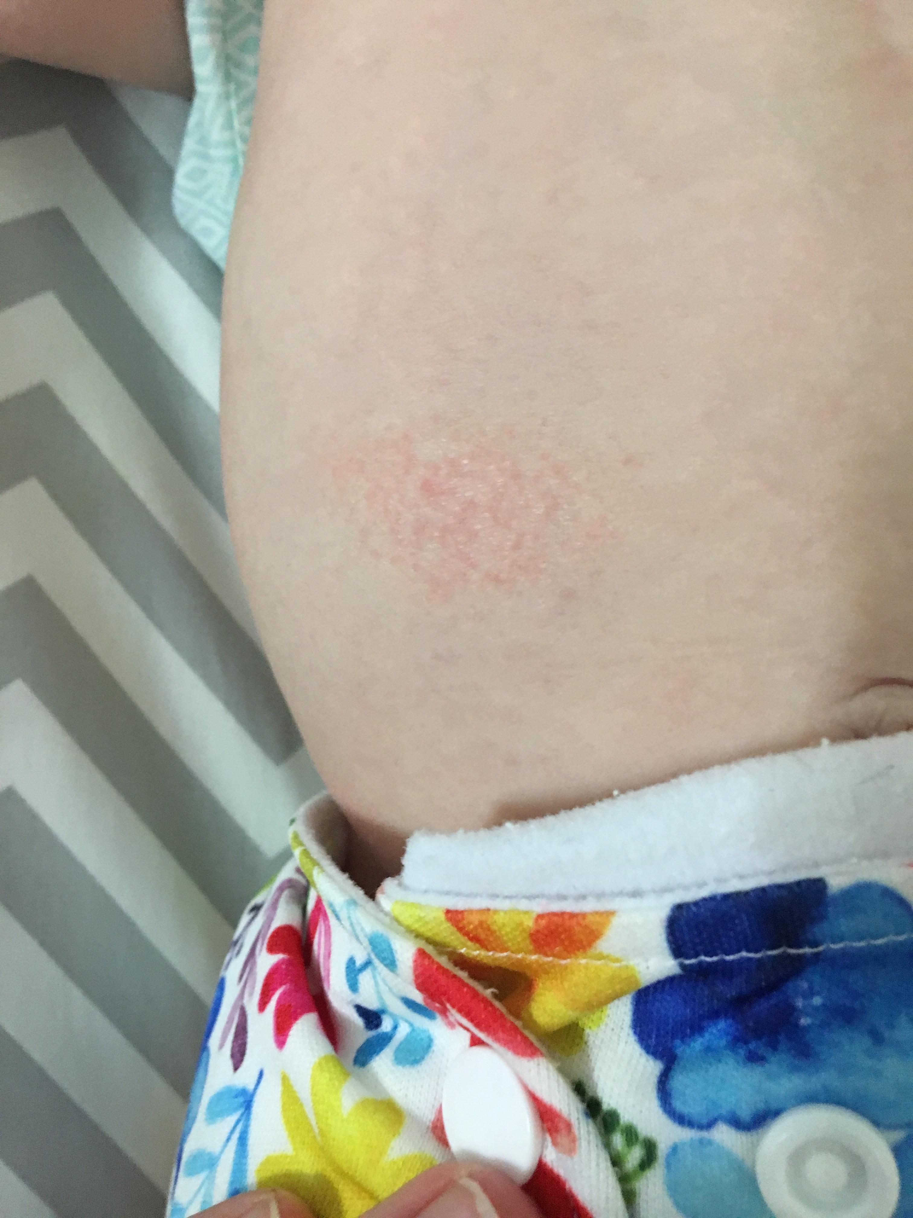 What is this rash and how can I make it go away and never come back? (Info in comments) r