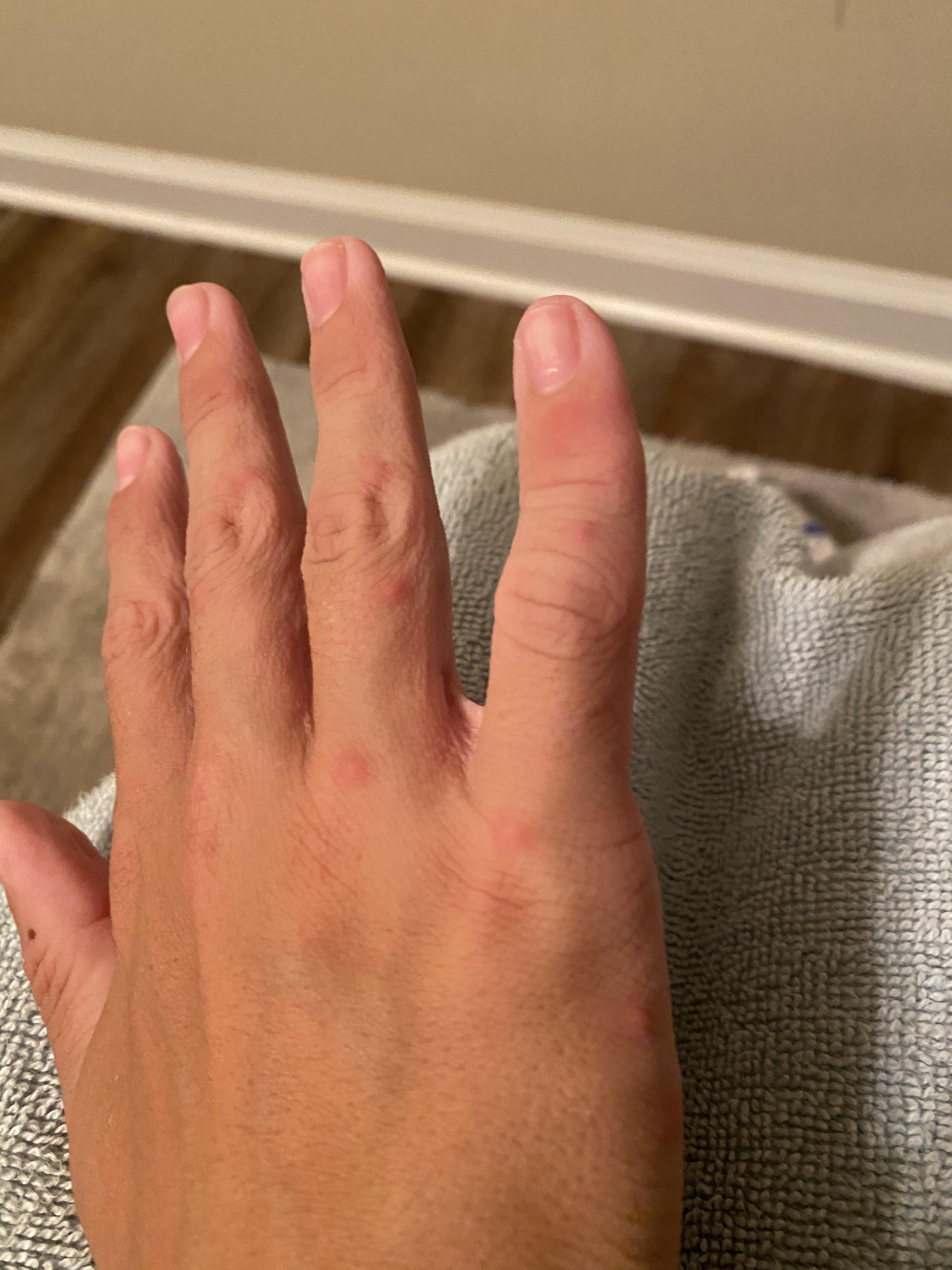 Itchy bumps all over body really bad on hands and arms. Help r/camping