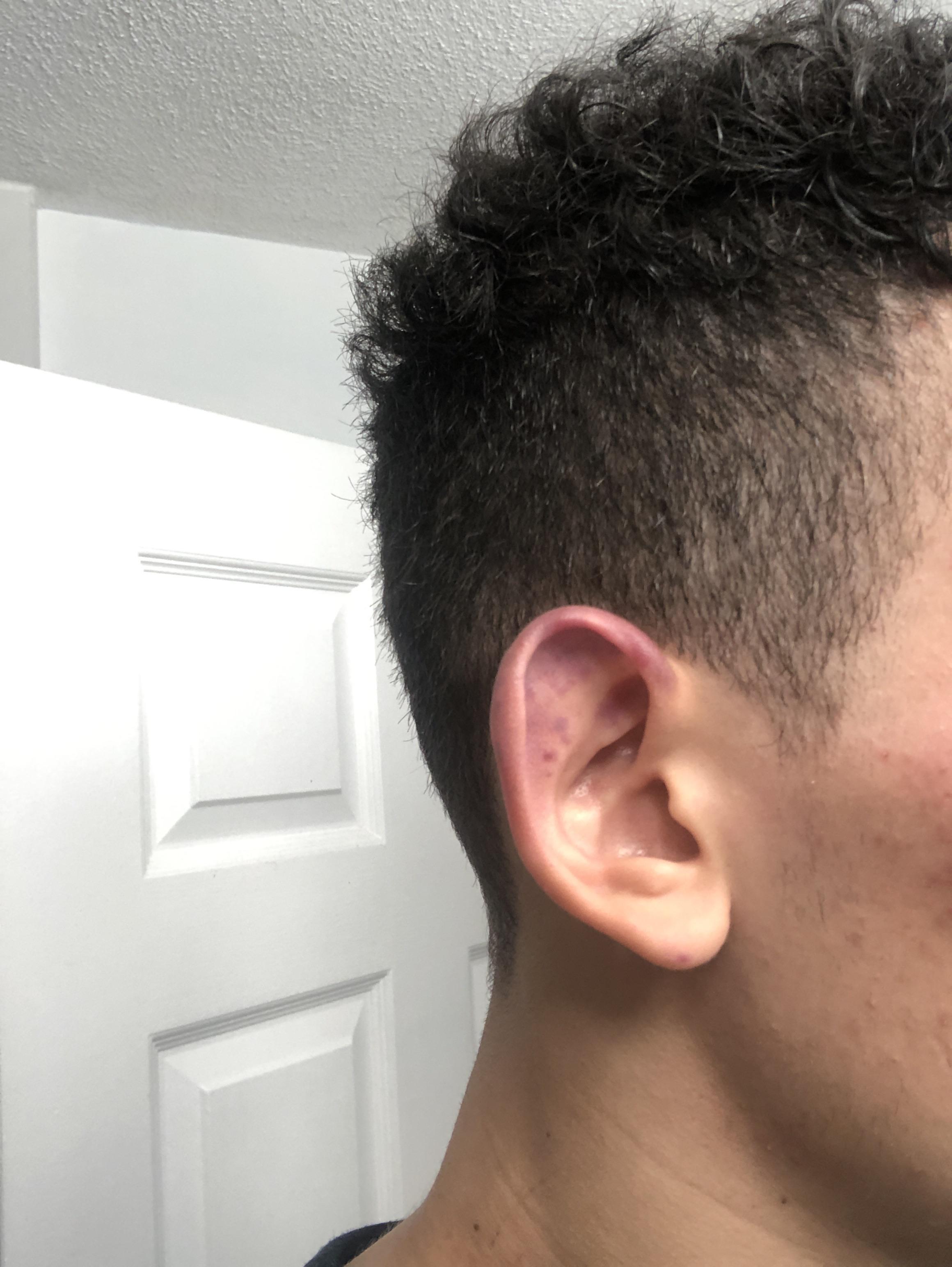 Am i getting cauliflower ear from this? What are some treatments? r