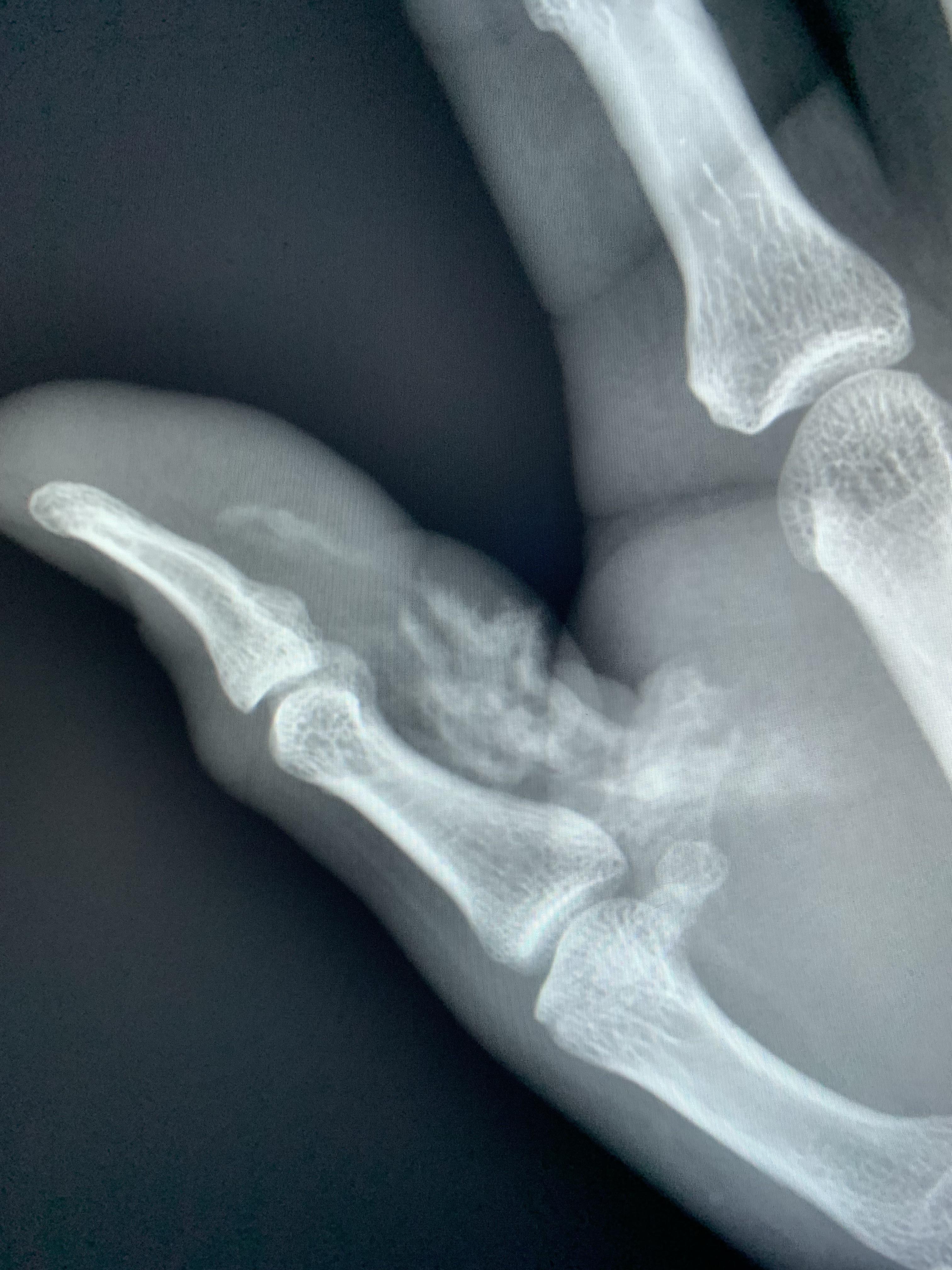 High pressure paint gun injection r/Radiology