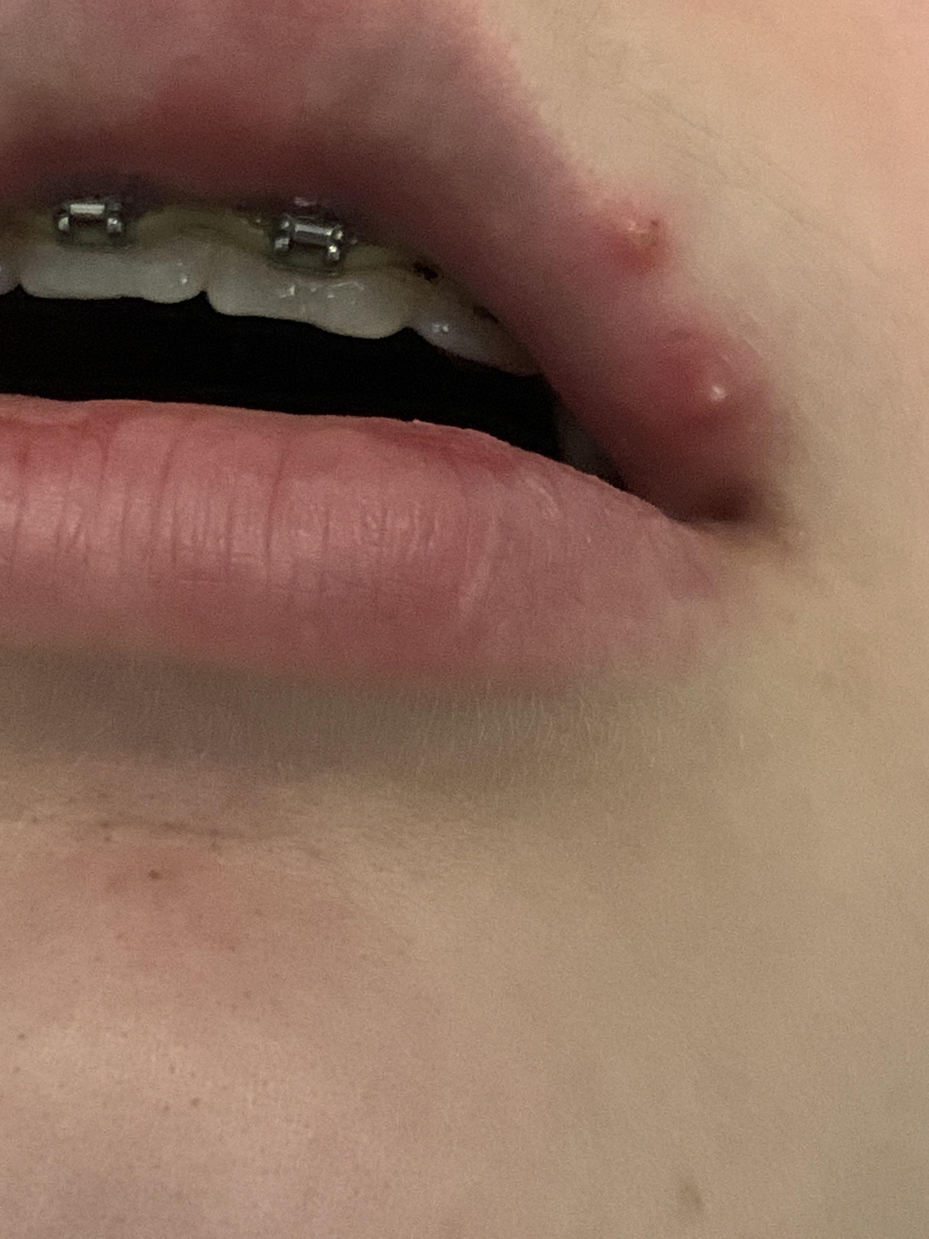 (F15) Two pimples on my top lip. I’m a virgin so it’s not herpes (at
