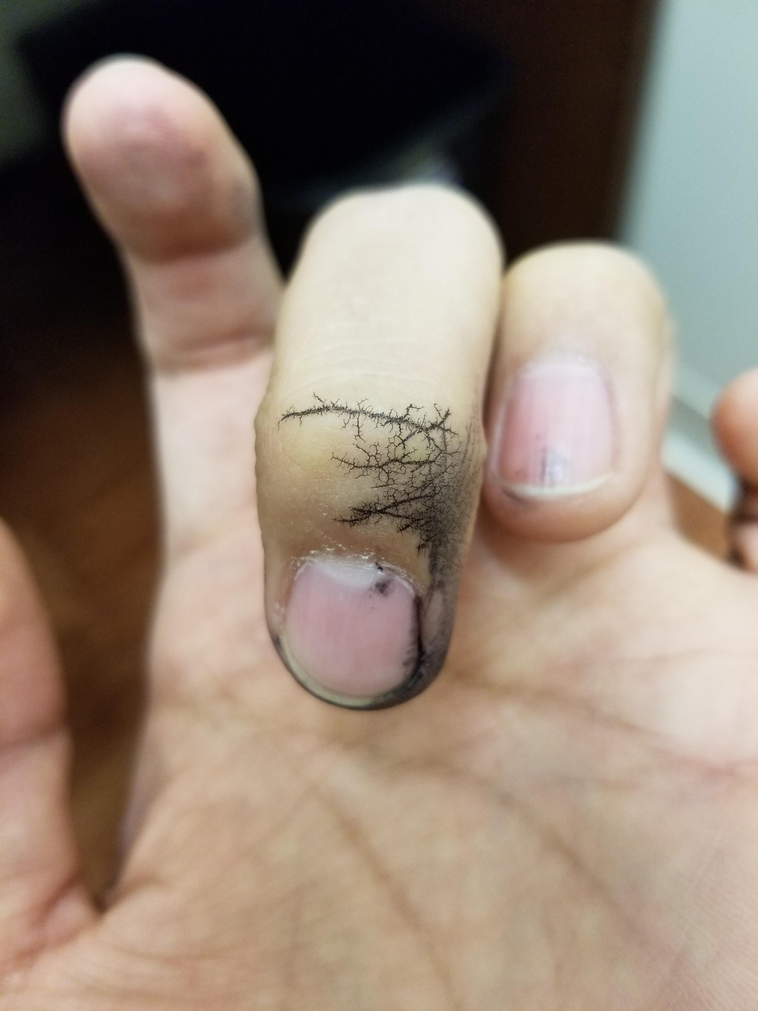 My marker exploded and the ink filled just the crevices of my skin. r