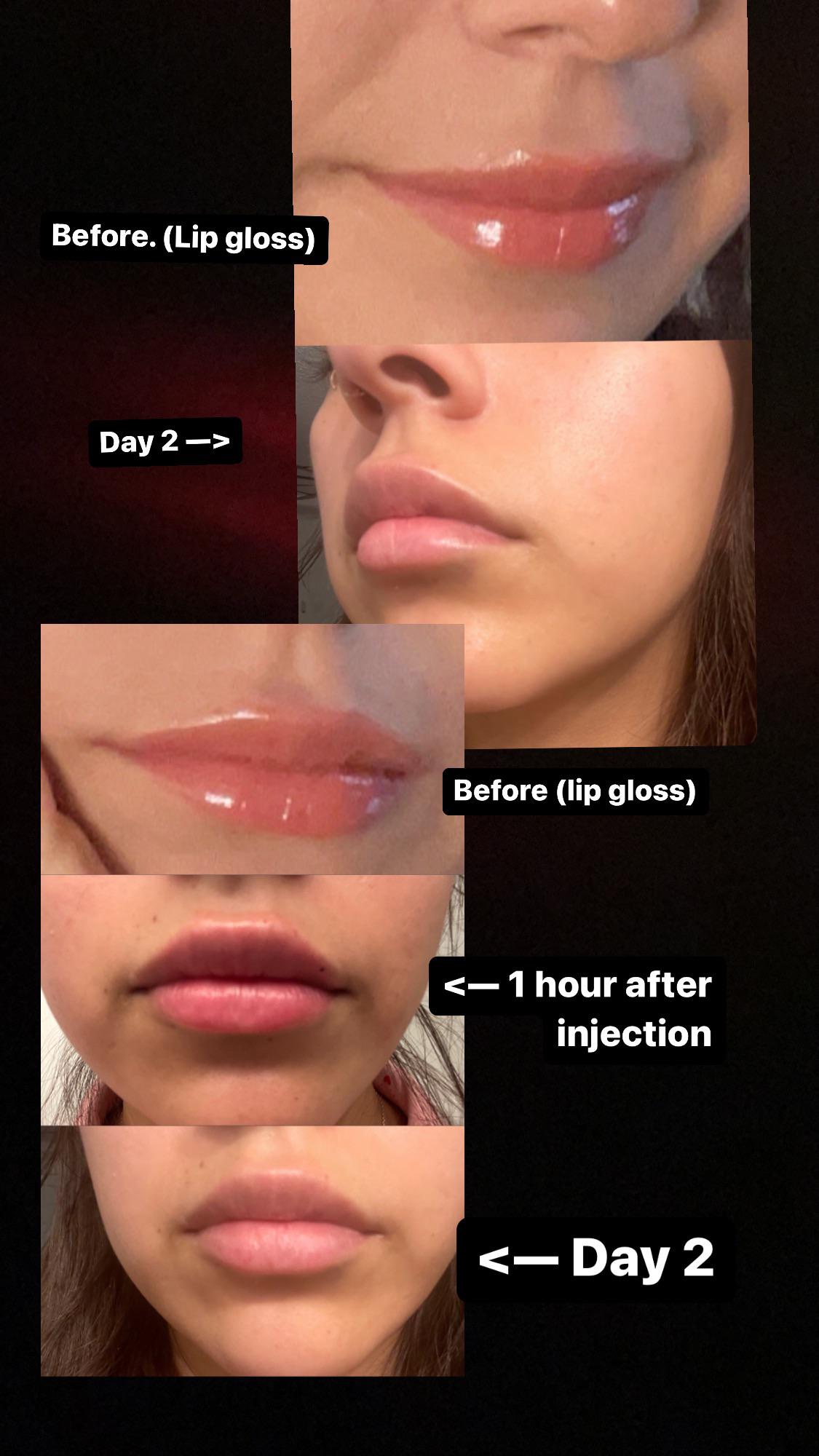 I got lip injections ! On day two; minimal bruising. Half a syringe r