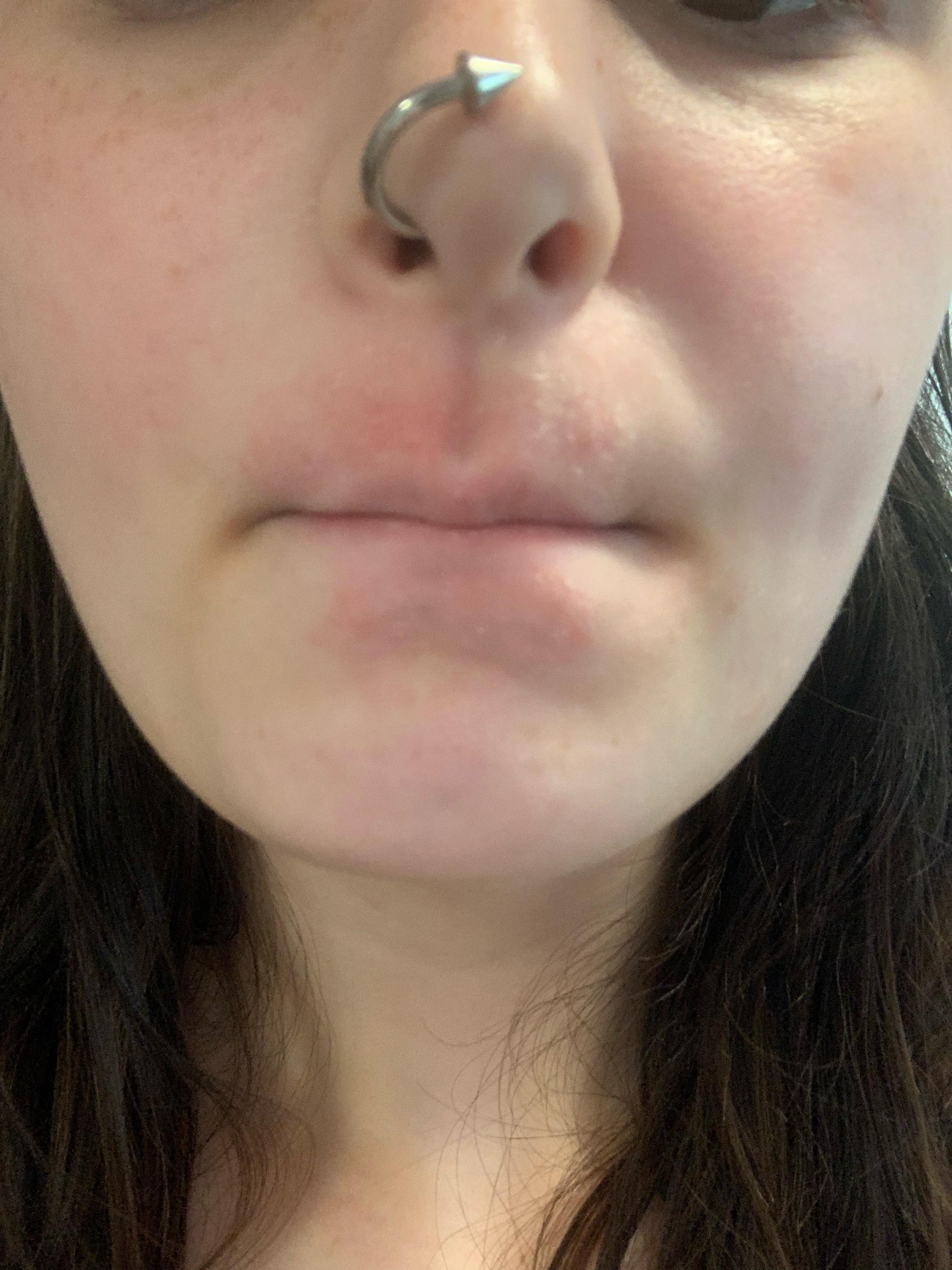 Help this has been on my mouth for months and won’t go away r/eczema