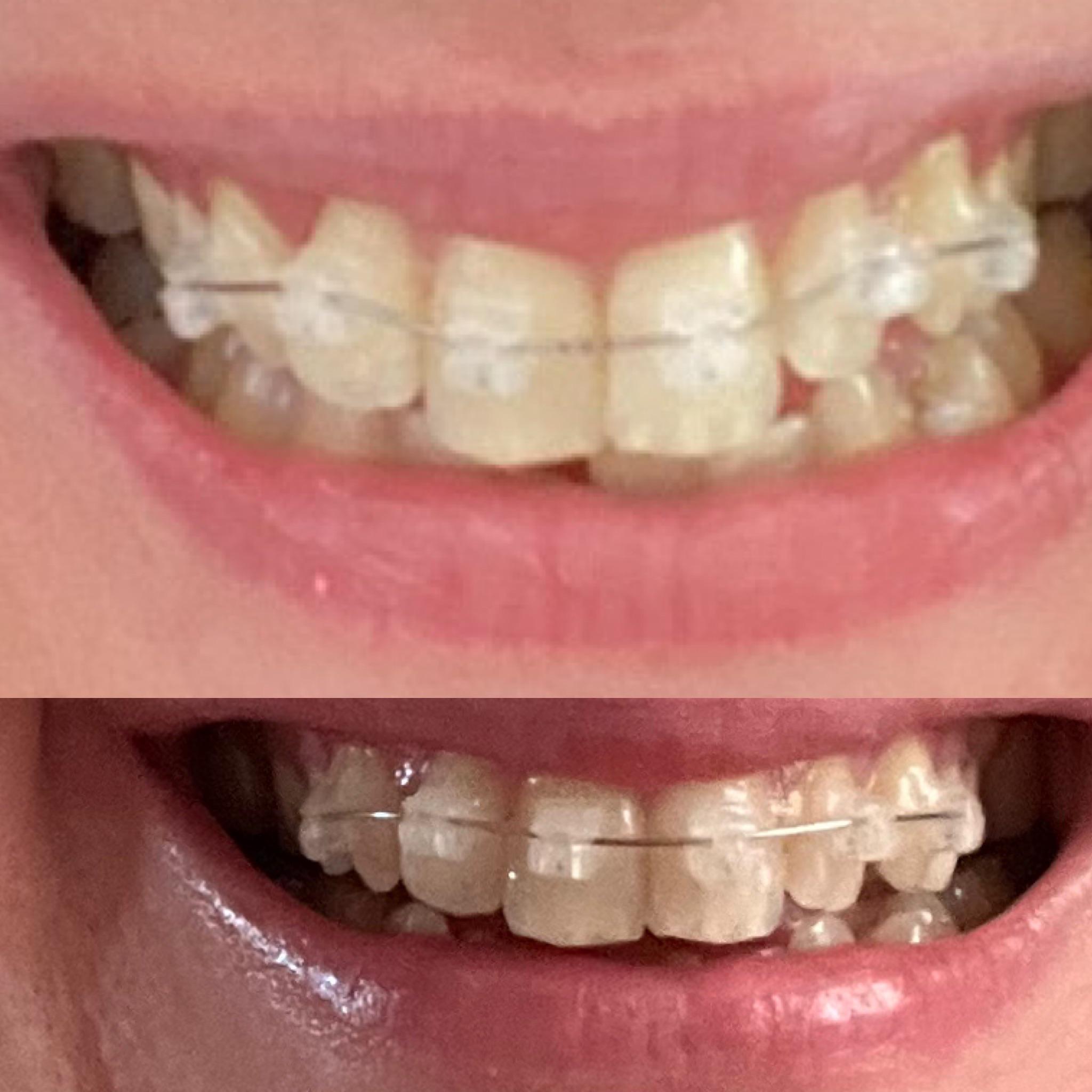 Starting my braces journey at 35! One month in with the first 8