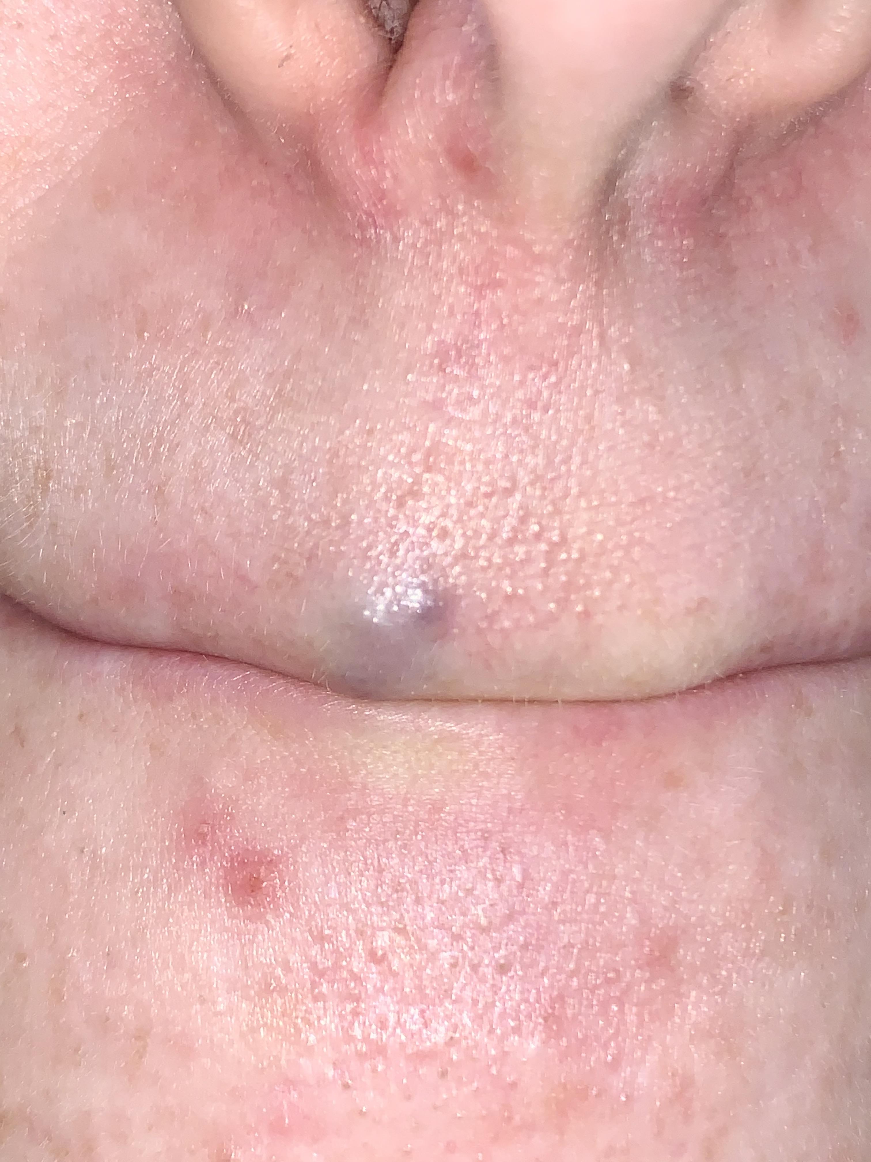 Bump on upper lip turning purple? The bump doesn’t hurt and has been